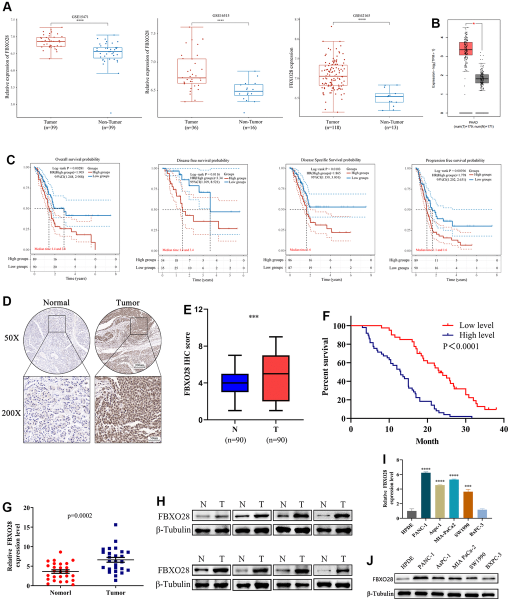 FBXO28 is overexpressed in pancreatic cancer and is associated with poor prognosis. (A, B) In the GSE15471, GSE16515, GSE62165, and GEPIA2 datasets, pancreatic cancer (PC) tissue specimens had substantially higher levels of FBXO28 expression than paracancerous tissue specimens. (C) Based on data from The Cancer Genome Atlas database, Kaplan–Meier analysis reveals that FBXO28 expression is associated with overall survival (OS), disease-free survival (DFS), disease-specific survival (DSS), and progression-free survival (PFS) in patients with PC. (D, E) Typical IHC images show high expression of FBXO28 in pancreatic cancer tissues (magnification: ×50, ×200). (F) Kaplan–Meier survival curves for high and low expression of FBXO28 in patients with PC. (G, H) FBXO28 expression in PC and paracancerous tissues detected by qRT-PCR and western blot. (I, J) FBXO28 expression in five PC cells was examined using qRT-PCR and western blot analysis, with β-tubulin serving as a control variable. ***P 