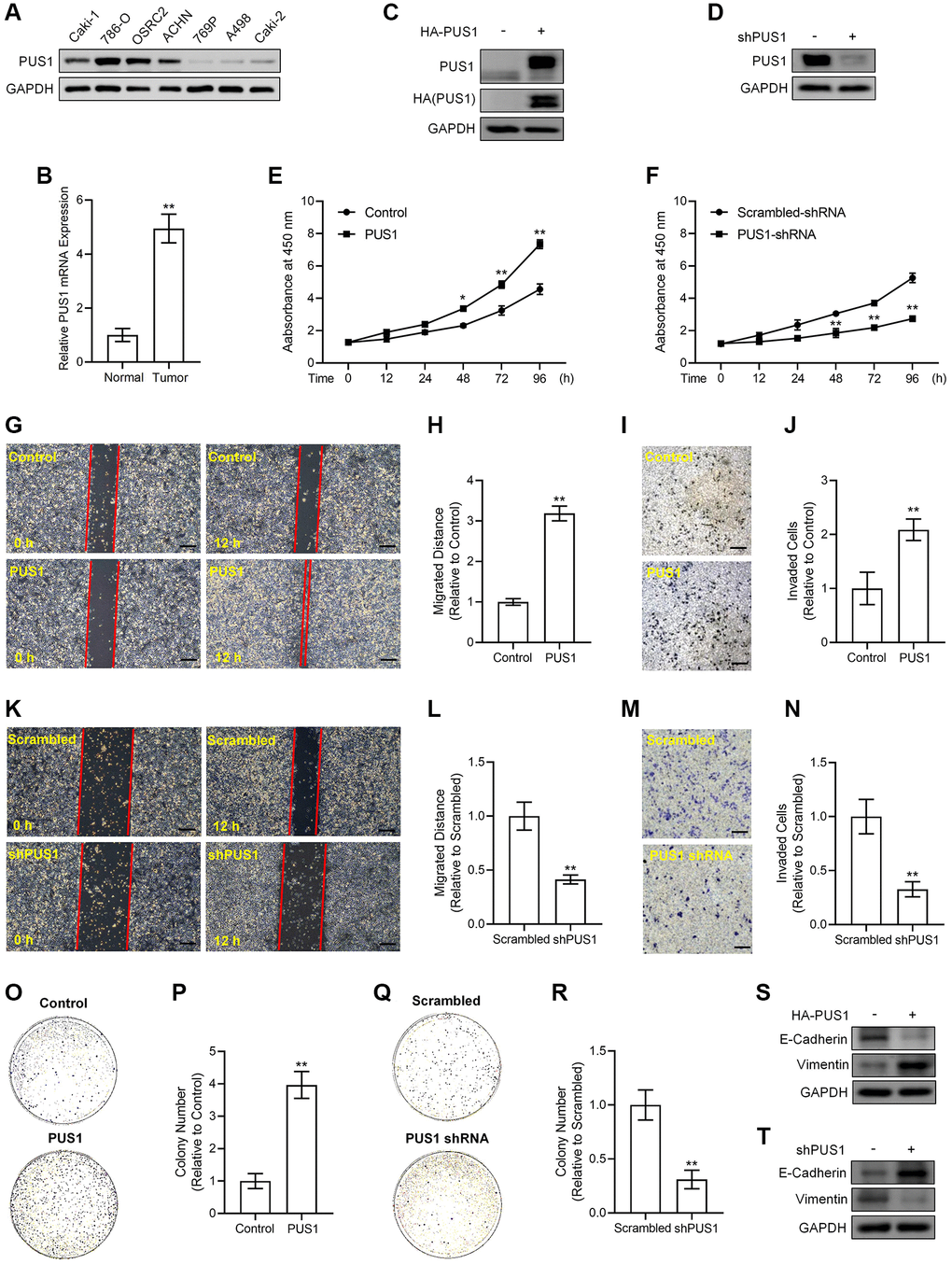 Alterations in PUS1 expression affect A498 cell and ACHN cell viability, migration, invasion, colony formation, and the expression of E-Cadherin and Vimentin. (A) The protein expression of PUS1 in different RCC cell lines. (B) The mRNA expression levels of PUS1 in cancer tissues and adjacent normal epithelial tissues from patients with RCC. N = 10. (C) A498 cells are infected with PUS1-LV and PUS1 expression was detected by western blot. (D) ACHN cells are infected with PUS1-shRNA-LV and PUS1 expression was detected by western blot. (E) A498 cells are infected with PUS1-LV and cell viability was measured. (F) ACHN cells are infected with PUS1-shRNA-LV and cell viability was measured. (G) A498 cells are infected with PUS1-LV and cell migration was determined by wound healing assay. (H) Quantitative statistics of (G). (I) A498 cells are infected with PUS1-LV and cell invasion was detected by matrigel-transwell assay. (J) Quantitative statistics of (I). (K) ACHN cells are infected with PUS1-shRNA-LV and cell migration was determined by wound healing assay. (L) Quantitative statistics of (K). (M) ACHN cells are infected with PUS1-shRNA-LV and cell invasion was detected by matrigel-transwell assay. (N) Quantitative statistics of (M). (O) A498 cells are infected with PUS1-LV and cell colony formation was performed. (P) Quantitative statistics of (O). (Q) ACHN cells are infected with PUS1-shRNA-LV and cell colony formation was performed. (R) Quantitative statistics of (Q). (S) Protein levels of E-Cadherin and Vimentin in A498 cells infected with PUS1-LV. (T) Protein levels of E-Cadherin and Vimentin in ACHN cells infected with PUS1-shRNA-LV. SD, error bar; **p *p 