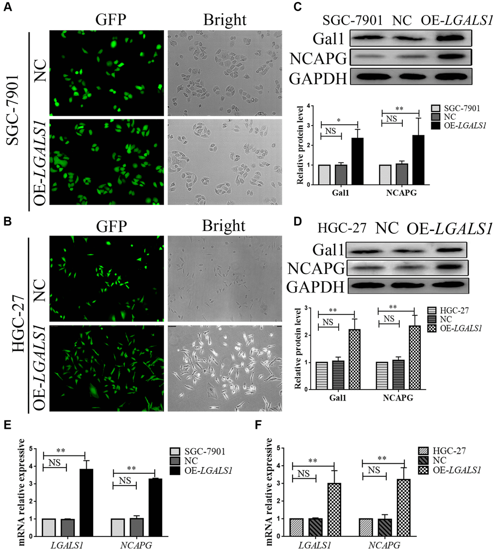 LGALS1 regulates NCAPG at the mRNA and protein levels. Transduction efficiency confirmed by green fluorescent protein (GFP) assay in (A) SGC-7901 cells and (B) HGC-27 cells. Original magnification 200×. (C, D) Western blot confirmation of stable overexpression of Gal1 and NCAPG in (C) SGC-7901 and (D) HGC-27 cells when LGALS1 was overexpressed. (E, F) Quantitative real-time PCR (qRT-PCR) analysis of LGALS1 and NCAPG expression in (E) SGC-7901 and (F) HGC-27 cells when LGALS1 was overexpressed. Abbreviations: OE-LGALS1: Overexpression of LGALS1; NC: negative control (empty vector); NS: not significant. *P **P 