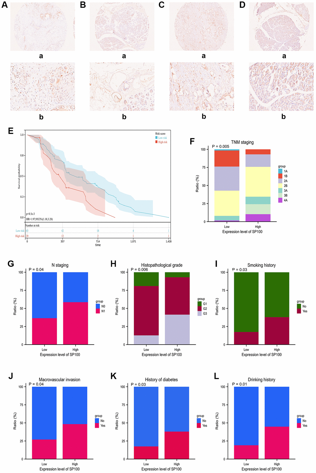 The immunohistochemical staining characteristics and expression levels of SP100 in PAAD patient tissues and their correlation with clinical features of PAAD patients. (A, B) The immunohistochemical staining features of SP100 in the pancreatic cancer tissue and adjacent tissue of patient ZCPA190705 were examined at 10X (a) and 40X (b) magnification, respectively; (C, D) The immunohistochemical staining features of SP100 in the pancreatic cancer tissue and adjacent tissue of patient ZCPA190713 were examined at 10X (a) and 40X (b) magnification, respectively; (E) The increased expression level of SP100 was significantly correlated with shorter OS; (F) The increased expression level of SP100 was significantly correlated with later TNM staging; (G) The increased expression level of SP100 was significantly correlated with later N staging; (H) The increased expression level of SP100 was significantly correlated with higher pathological grade; (I) The increased expression level of SP100 was significantly correlated with smoking history; (J) The increased expression level of SP100 was significantly correlated with macrovascular invasion; (K) The increased expression level of SP100 was significantly correlated with history of diabetes; (L) The increased expression level of SP100 was significantly correlated with drinking history.