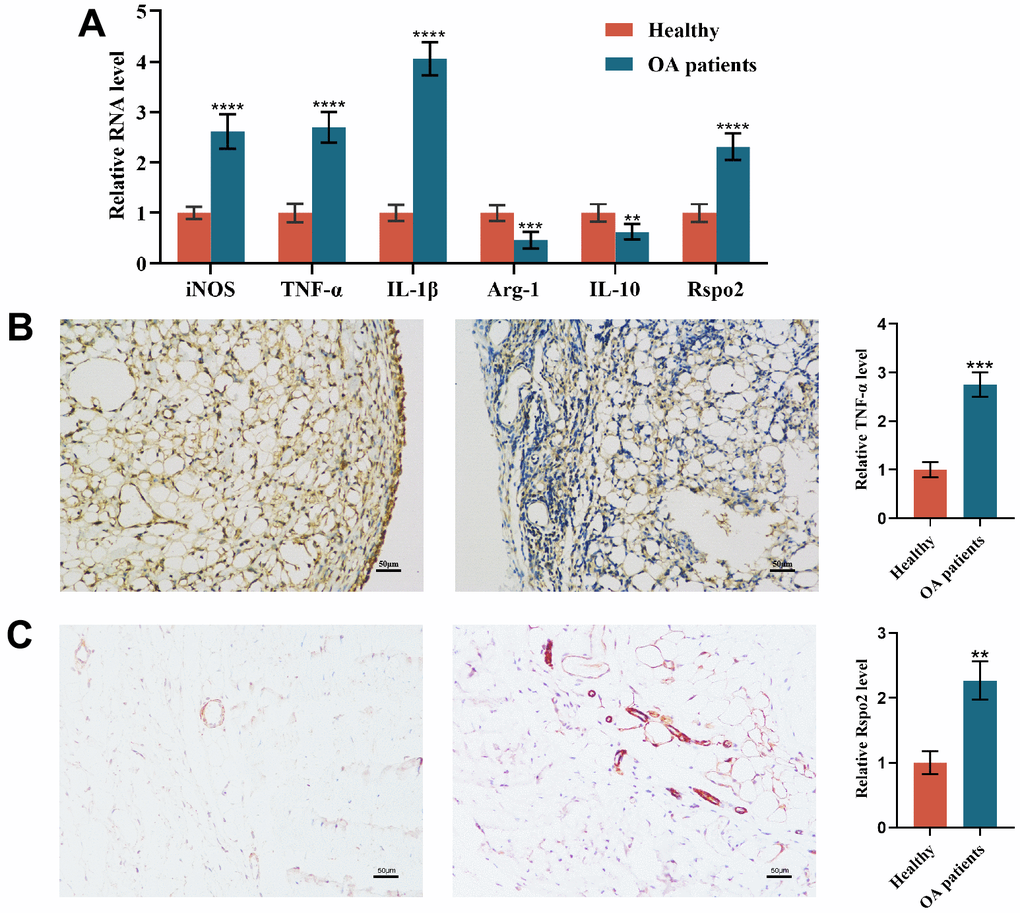 Macrophage polarization in the synovial tissue of osteoarthritis patients. (A) qRT-PCR was used to detect the gene expression of M1 macrophage markers (TNF-α, IL-1β, and iNOS), M2 macrophage markers (IL-10 and Arg-1) and Rspo2 in the synovial tissue of the two groups of patients. (B) TNF-α immunohistochemical staining for synovial inflammation in the two groups was performed. (C) Rspo2 immunohistochemical staining for synovial inflammation in the two groups was performed. The data are represented as the mean ± S.D. of three independent experiments (n = 3). ns: Not significant vs Normal group; **p p p 