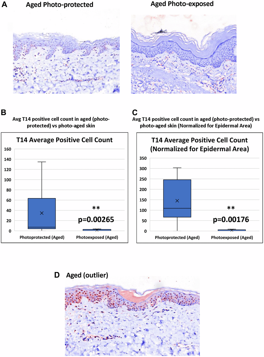 Effect of UV-light on levels of T14 in skin. (A) Immunohistochemistry of AChE T14 peptide expression is higher in aged photo-protected (50 to 70 years old) skin compared to photo-aged skin (50 to 70 years old. N=10 in each group. (B) Average number of epidermal cells with a positive AChE T14 peptide antibody stain. Aged (photo-protected) skin samples have a significantly higher expression (p value of 0.00265) of T14 positive cells compared to its expression in age matched, photo-aged skin samples. (C) Average number of epidermal cells with a positive AChE T14 peptide antibody stain normalized by epidermal area. Aged (photo-protected) skin samples have a significantly higher expression (p value of 0.00176) of T14 positive cells per epidermal area compared to its expression in age-matched photo-exposed skin. (D) Immunohistochemistry of AChE T14 peptide expression is higher in 1 outlier of the aged group.