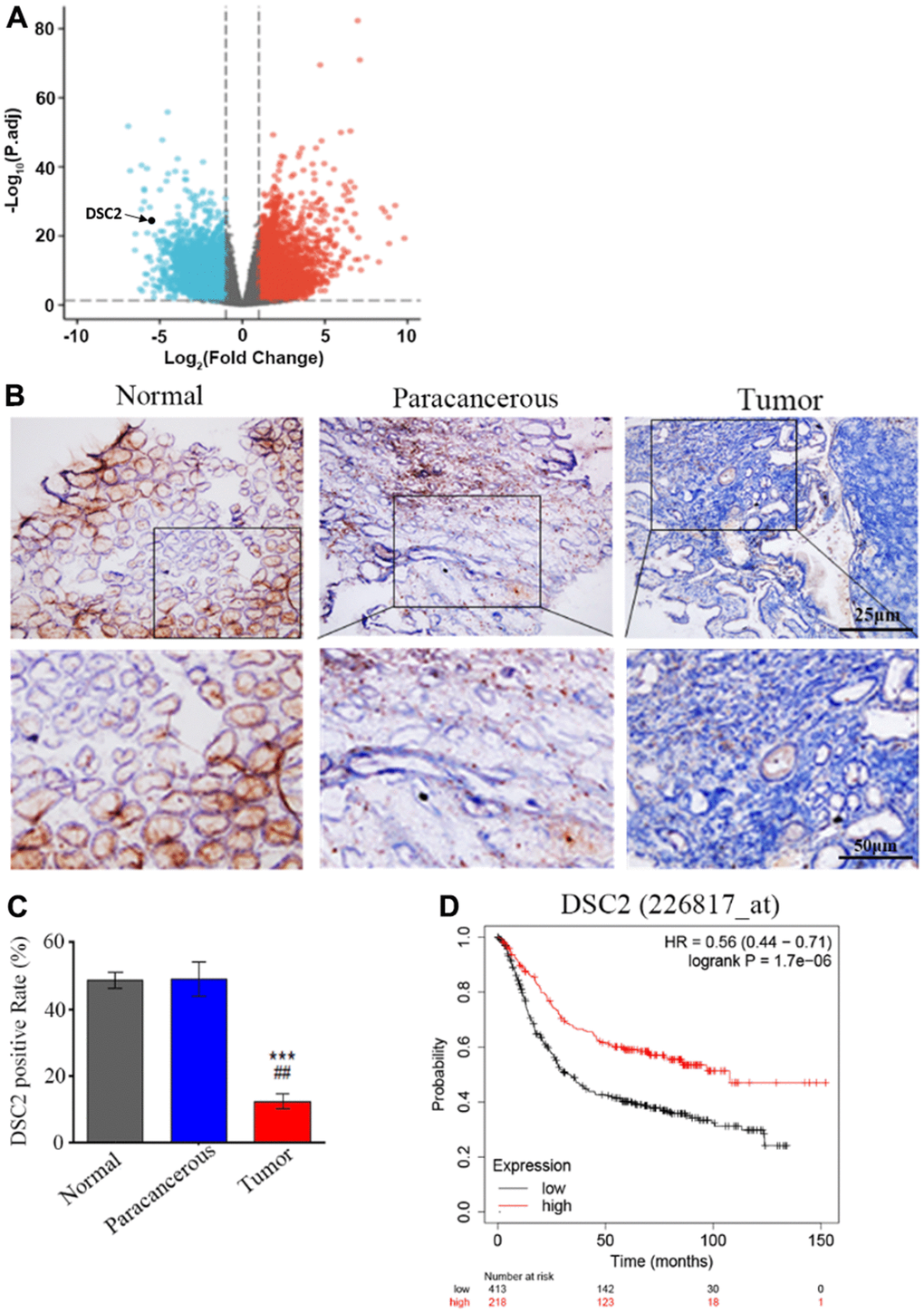 DSC2 is downregulated in GC tumors and its expression is prognostic for worse overall survival. (A) Volcano plot displayed the pattern of upregulated and downregulated genes in normal and tumor specimens of GC patients from TCGA data, the red dots in the right plot represented upregulated genes, blue dots denoted downregulated genes with statistical significance, and gray dots exhibited no differentially expressed genes. (B, C) The expressions of DSC2 in adjacent normal tissues (N), paracancerous tissues (P), and GC tissues (T) of clinical specimens were tested through IHC, blue is the nucleus and brownish yellow is the DSC2 expression, the scale bar = 25 μm, ***pD) The Kaplan-Meier curves (overall survival) of GC patients with different expression of DSC2, the data was obtained from the website: https://kmplot.com/analysis/index.php?p=service.