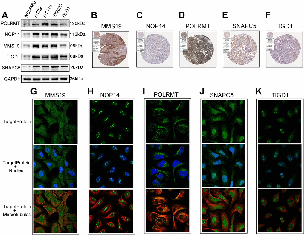 The expression of the identified five CDM genes from the human protein atlas database (HPA). (A) Western blotting. The protein expression of five CDM genes in the normal derived colon mucosal (NCM460) and colon cancer cells (HT29, HCT116, SW620 and DLD1). (B–F) Protein expressions of five CDM genes in colon cancer tissue specimens by immunohistochemical; (B) for MMS19; (C) for NOP14; (D) for POLRMT; (E) for SNAPC5; (F) for TIGD1. (G–K) Protein expressions and localization of five CDM genes in U2-OC cell by immunofluorescence (green represents five CDM-associated protein, blue represents nucleus and red represents microtubule); (G) for MMS19; (H) for NOP14; (I) for POLRMT; (J) for SNAPC5; (K) for TIGD1.