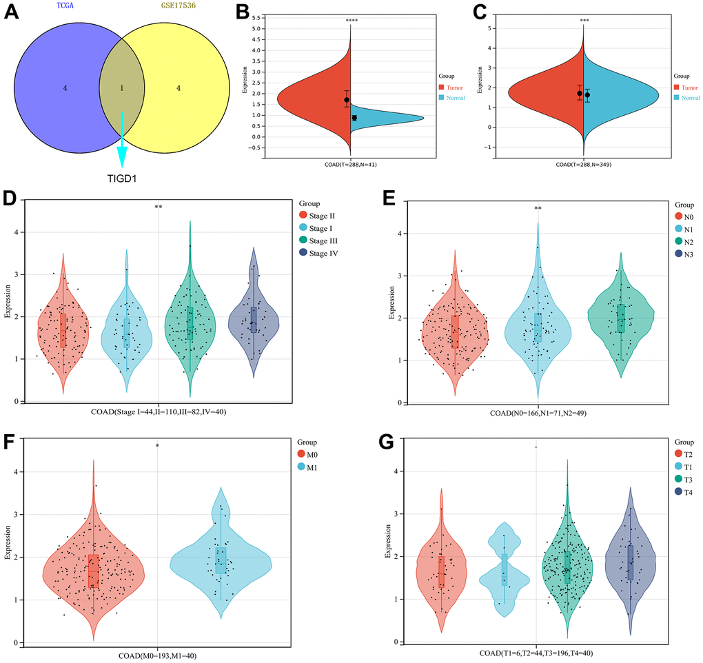 The expression and clinicopathological classifications of TIGD1 in TCGA-COAD cohort. (A) Venn plot. Kaplan-Meier survival analysis for five CDM-associated genes in in TCGA–COAD and GSE17536 cohort. Blue represents TCGA-COAD and yellow represents GSE17536 cohort. (B, C) Violin plot. The mRNA expression of TIGD1. Red represents tumour and blue represents normal. (B) for TCGA-COAD dataset (pC) for TCGA-COAD and GTEx dataset (pD) Violin plot. Correlation between tumour stage and TIGD1 expression in TCGA-COAD cohort. Pink represents I stage, green represents II stage, Cyan represents III stage and violet represents IV stage (pE) Violin plot. Correlation between lymph node metastasis (N) and TIGD1 expression in TCGA-COAD cohort. Pink represents N0 (not metastasis), blue represents N1 (1-3 regional lymph node metastases) and cyan represents N2 (4 or more regional lymph node metastases) (pF) Violin plot. Correlation between metastasis (M) and TIGD1 expression in TCGA-COAD cohort. Pink represents M0 (not metastasis), blue represents M1 (metastases) (pG) Violin plot. Correlation between depth of tumor invasion (T) and TIGD1 expression in TCGA-COAD cohort. Pink represents T1, blue represents T2, Cyan represents T3 and violet represents T4 (p>0.05).