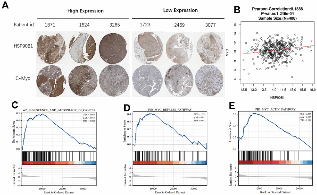 HSP90B1 and c-Myc are highly correlated. (A) Expression of HSP90B1 and c-Myc protein in bladder cancer. (B) Expression of HSP90B1 and c-Myc mRNA in bladder cancer samples. (C–E) Gene enrichment analysis of HSP90B1 in bladder cancer.