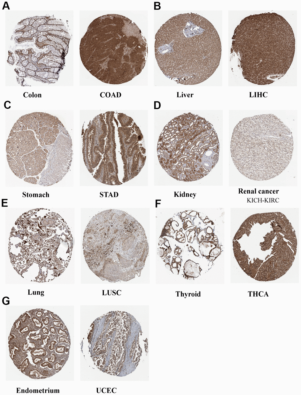 Representative IHC staining of N6AMT1 in eight normal (left) and tumor (right) tissues of the colon (A), liver (B), stomach (C), kidney (D), lung (E), thyroid (F) and endometrium (G).