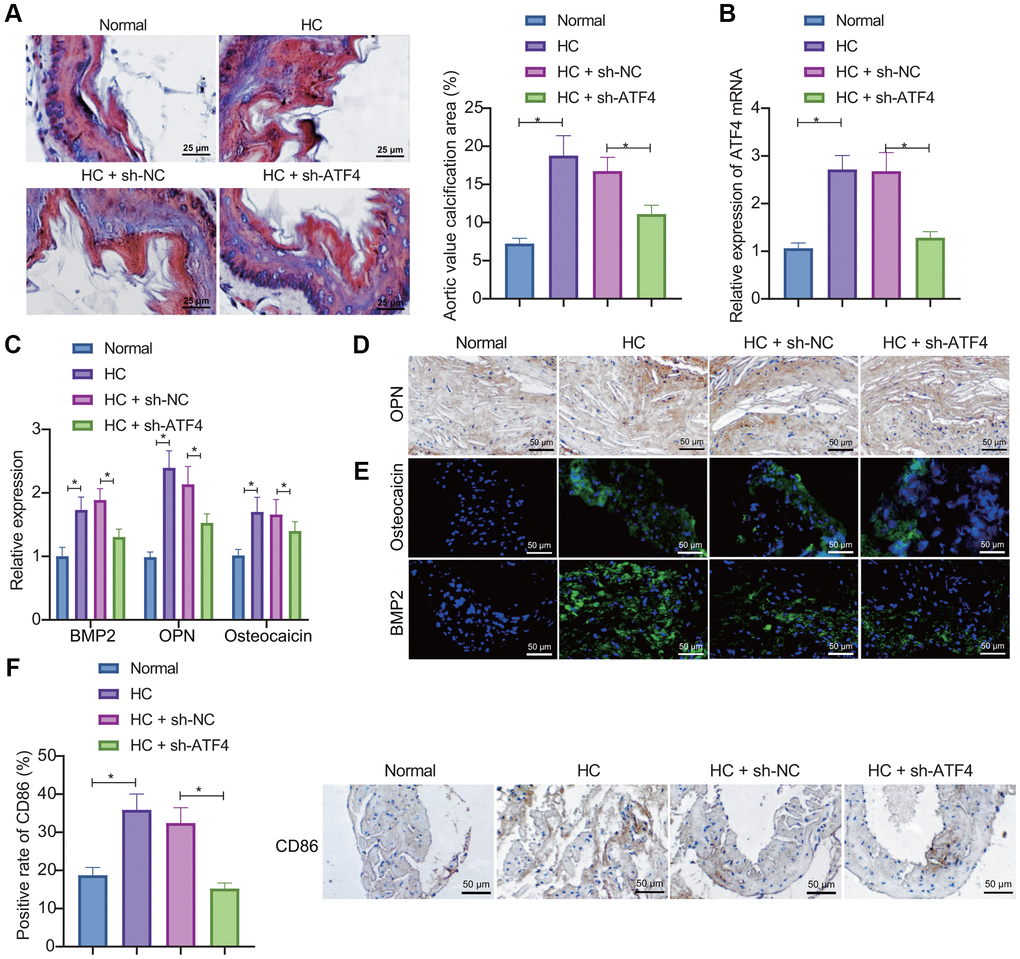 ATF4 silencing represses AVC in mice. (A) ARS staining of aortic valve leaflet calcification in HC-induced mice treated with sh-ATF4. (B) Expression of ATF4 in the aortic valve tissue of HC-induced mice treated with sh-ATF4 detected by RT-qPCR. (C–E) Expression of BMP2, OPN, and osteocalcin in the aortic valve tissue of HC-induced mice treated with sh-ATF4 detected by RT-qPCR, IHC, and IF. (F) IHC of CD86 protein in the aortic valve tissue of HC-induced mice treated with sh-ATF4. *p n = 8. Measurement data were expressed as mean ± standard deviation. Data obeying normal distribution and homogeneity of variance among multiple groups were analyzed by one-way ANOVA with Tukey's post hoc tests.