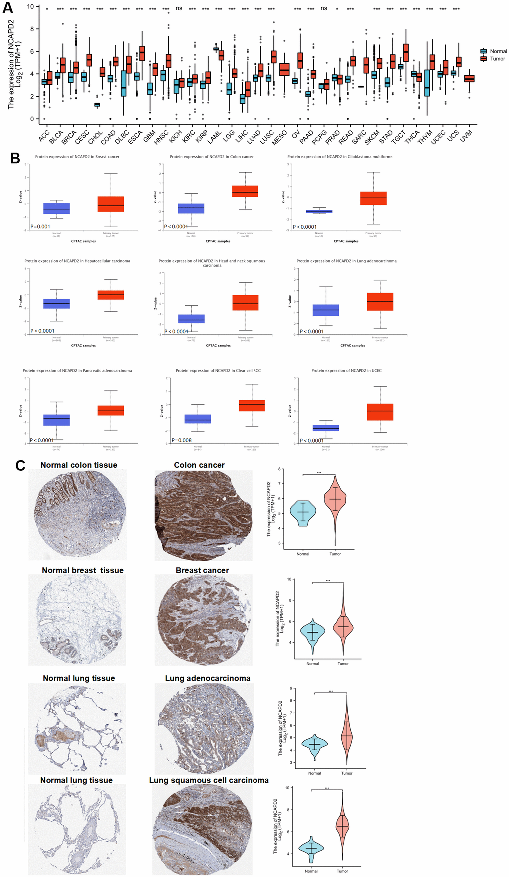 NCAPD2 expression in different databases (***P P P  (A) NCAPD2 expression from TCGA and GTEx. (B) NCAPD2 expression in CPTAC for some cancers. (C) NCAPD2 expression was higher in colon cancer, breast cancer, lung adenocarcinoma and lung squamous cell carcinoma than in corresponding normal tissues.