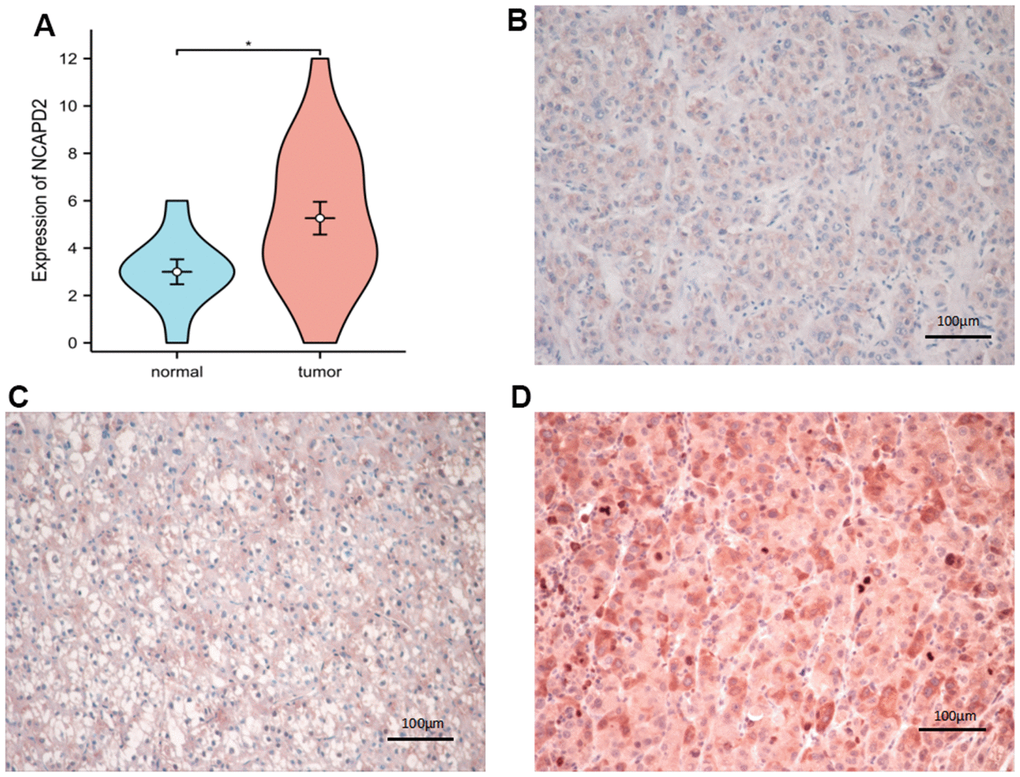 The expression of NCAPD2 protein in normal tissues and LIHC by immunohistochemistry (EnVision; original magnification, ×200). (A) NCAPD2 had higher expression in LIHC than normal tissues. (B) Weak positive expression of NCAPD2 in LIHC. (C) Moderate positive expression of NCAPD2 in LIHC. (D) Strong positive expression of NCAPD2 in LIHC. (*P