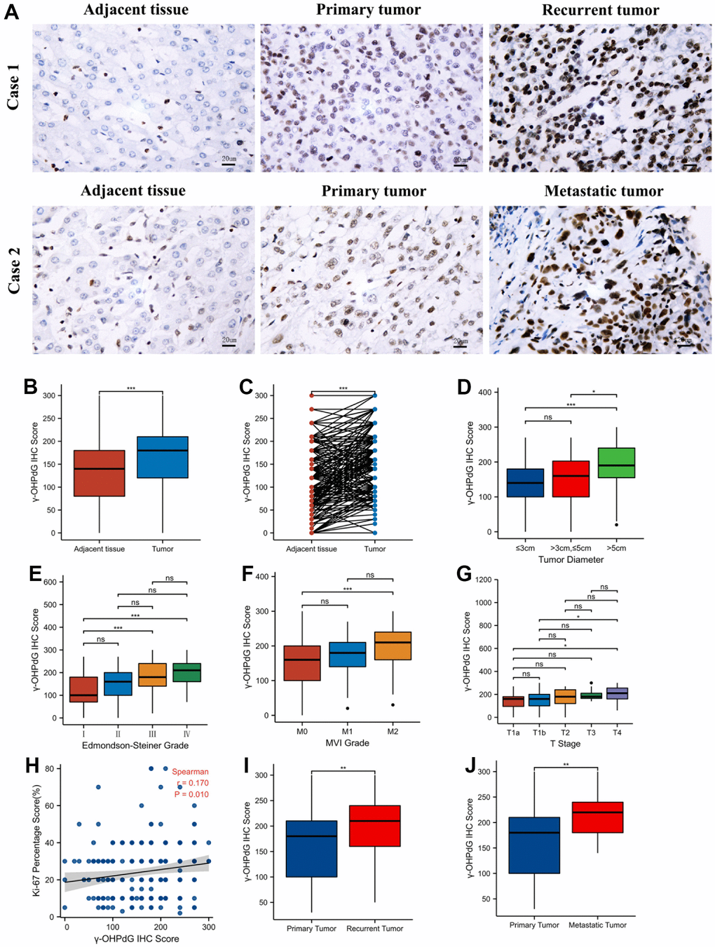 The levels of γ-OHPdG by IHC staining in the development of HCC. (A) The levels of γ-OHPdG in the adjacent tissues, primary tumors, the recurrent and metastatic tumor tissues (20×); (B, C) Comparison of the levels of γ-OHPdG in HCC and the adjacent tissues; (D–G) The histogram plot shows γ-OHPdG levels in tumor size, Edmondson-Steiner grades I–IV, MVI grades 0-2, T stages T1a-T4 HCC patients, respectively; (H) Dot plot between γ-OHPdG levels and ki67 percentage scores; (I, J) γ-OHPdG levels between the recurrent tumors/metastatic tumors and their primary HCC tissues.*P 