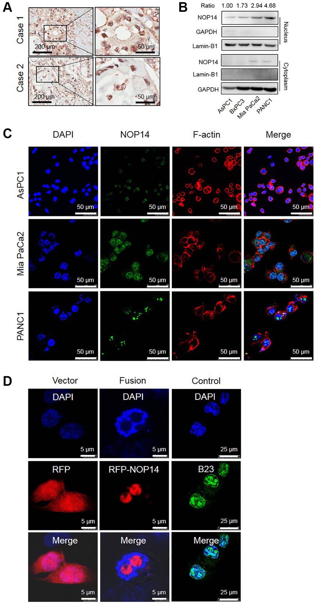 Subcellular localization of NOP14 in pancreatic cancer cells. (A) Immunohistochemical localization of NOP14 in pancreatic cancer tissues. (B) Western blot analysis of NOP14 in the nucleus and cytoplasm of different pancreatic cancer cell lines. Lamin B1 was used as the nuclear reference, and GAPDH was used as the cytoplasmic reference. Standardized grey ratio was shown on the top representing relative expression of NOP14 in nucleus. (C) Immunofluorescence analysis of NOP14 in pancreatic cancer cells under magnification 200×. Blue, DAPI-labeled nuclei; green, FITC-labeled anti-NOP14 antibody; red, phalloidin-labeled cytoskeletal F-actin; merge, superimposition of the above three images. (D) Immunofluorescence analysis of RFP-NOP14 expression in transfected PANC1 cancer cells. Blue, DAPI-labeled nuclei; red, RFP or RFP-NOP14; green, nucleolar protein B23; merge, superimposition of the above three images.
