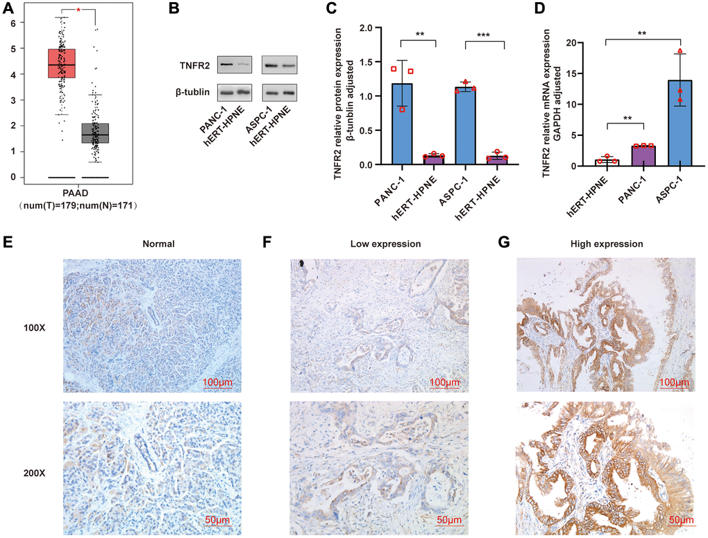 (A) TNFR2 gene was analyzed using GEPIA. (B, C) TNFR2 protein in PANC-1 and ASPC-1 cells were measured by western blot. (D) TNFR2 mRNA in PANC-1 and ASPC-1 cells were detected using qRT-PCR. (E) Immunohistochemical staining in normal pancreatic tissue. (F) Immunohistochemical staining in the low-expression group of pancreatic cancer tissue. (G) Immunohistochemical staining in the high-expression group of pancreatic cancer tissue.