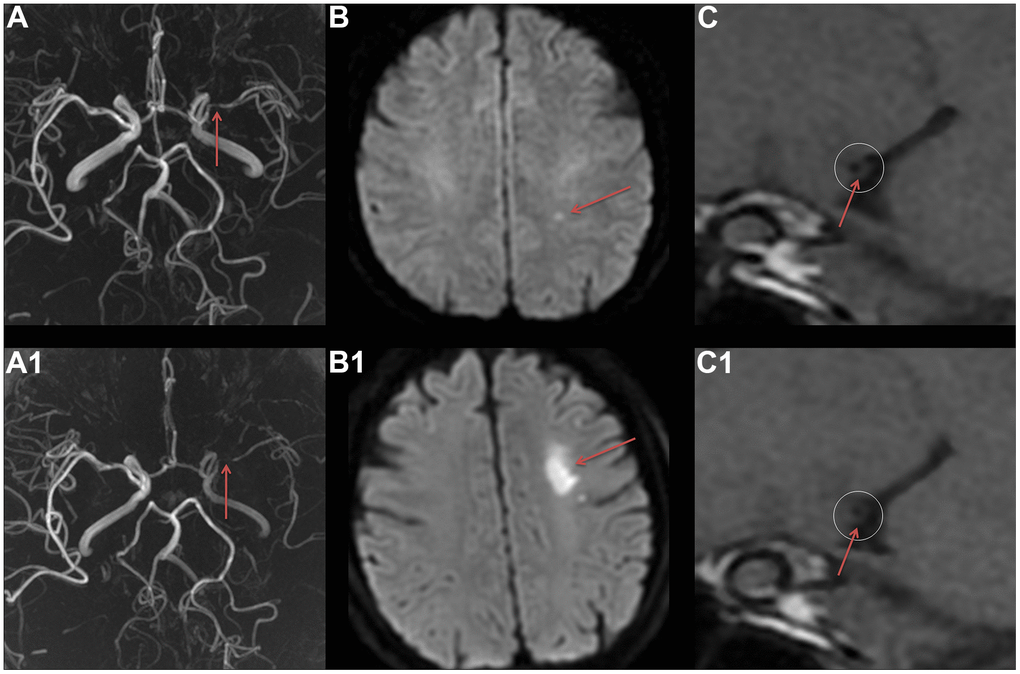 The VWMRI of MCA plaque characteristic in a patient with ischemic stroke recurrence. A female patient, 56 years old, experienced her first ischemic stroke in August 2019. MRA revealed severe stenosis of the M1 segment of the left MCA (A). At the same time, DWI displayed a punctate high signal in the left centrum semiovale (B), and VWMRI revealed centripetal thickening of the MCA and severe lumen stenosis (C). In November 2019, the patient experienced a recurrent ischemic stroke. MRA displayed an aggravated stenosis of the M1 segment of the left MCA (A1), and DWI showed a new patchy high signal in the left centrum semiovale (B1). Furthermore, VWMRI revealed an aggravated centripetal thickening of the MCA and a worsening lumen stenosis (C1).