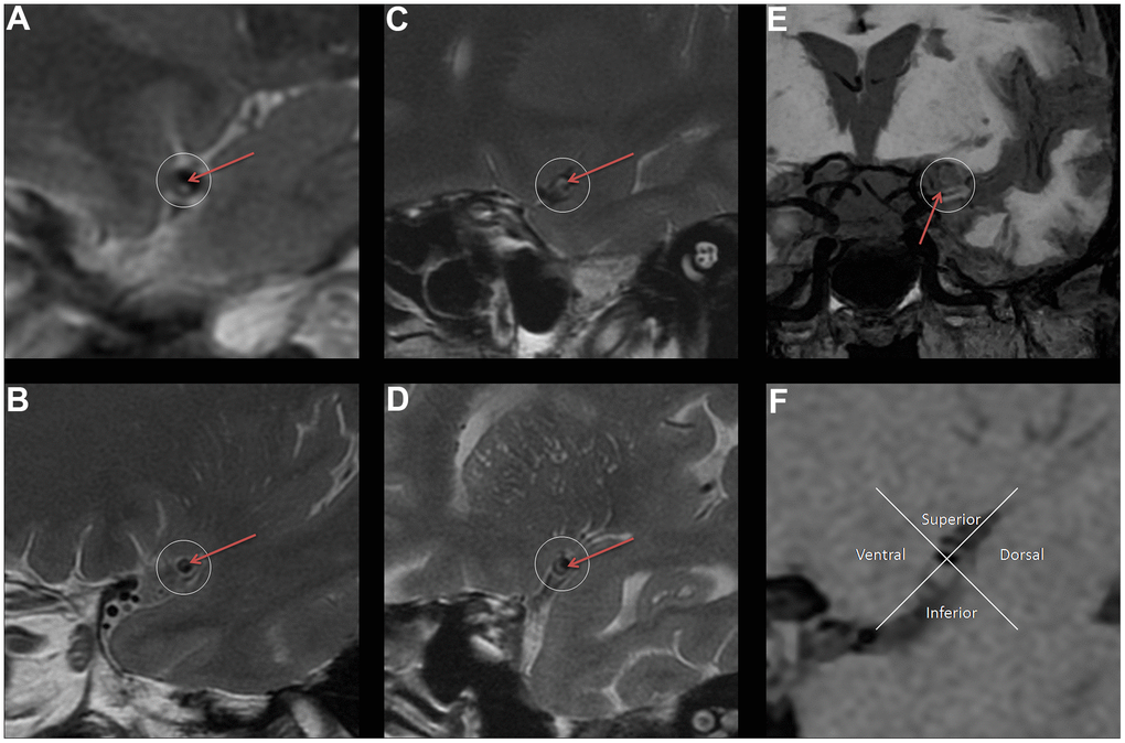 The legend introduction of VWMRI plaque characteristics. (A) Plaque surface is irregular (red arrow). (B) Plaque surface is smooth (red arrow). (C) Uneven thickness of fibrous cap (red arrow). (D) Uniform thickness of fibrous cap (red arrow). (E) Plaque involves the opening of the lenticulostriate arteries (red arrow). (F) Distribution of plaque (The plaque is mainly located in the inferior).