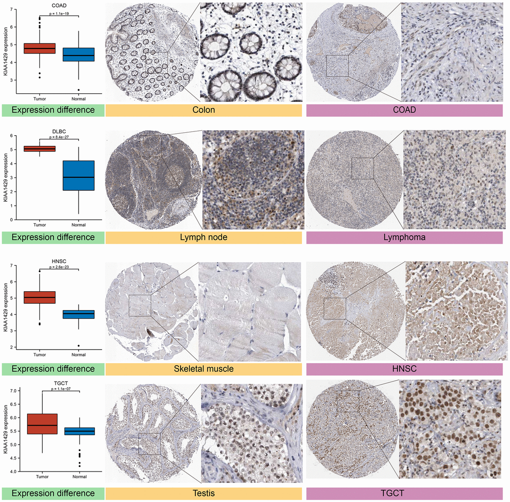 Differential expression of KIAA1429 at mRNA and protein levels in normal and tumor tissues.