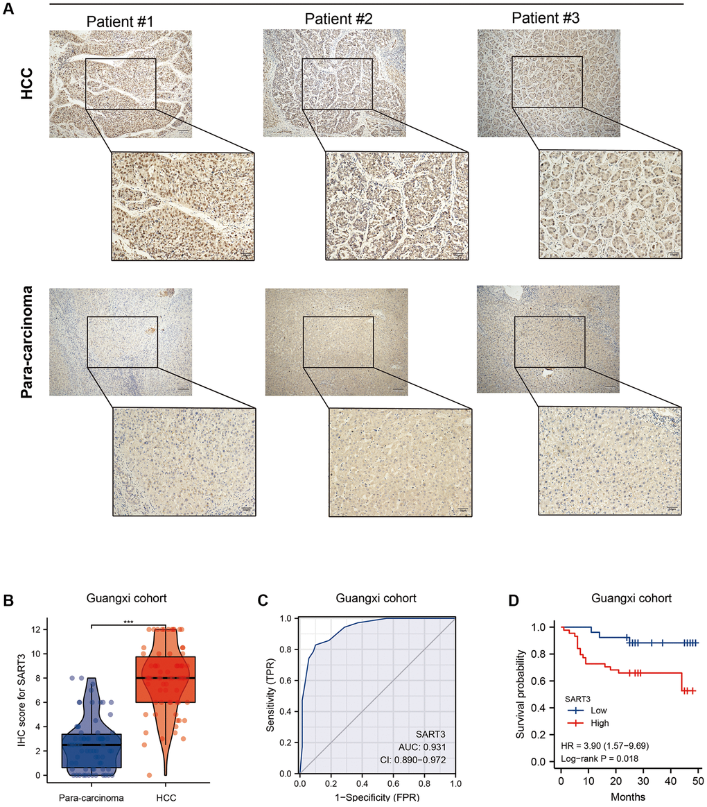 Validation of SART3 in patients with HCC in Guangxi. (A) Representative IHC images showing the in situ expression of SART3 in HCC and adjacent liver tissues. (B) Paired plots showing immunostaining scores of SART3 in HCC and adjacent liver tissues in the Guangxi cohort. (C) Diagnostic ROC curves of SART3 in the Guangxi cohort. (D) OS of SART3high and SART3low groups in the Guangxi cohort based on immunohistochemical staining scores.