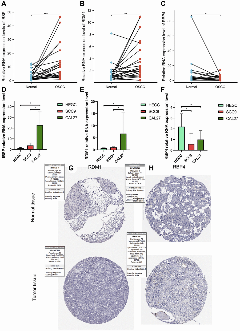 Validation of abnormal expression of 3 modeled genes in OSCC. (A, B) Higher relative mRNA expression levels of IBSP and RDM1 detected by QRT-PCR in OSCC tissues. (C) Lower relative mRNA expression levels of RBP4 detected by QRT-PCR in OSCC tissues. (D, E) Higher relative mRNA expression levels of IBSP and RDM1 detected by QRT-PCR in cal27 and scc9. (F) Lower relative mRNA expression levels of RBP4 detected by QRT-PCR in cal27 and scc9. (G, H) IHC images reflecting the expression of RDM1 and RBP4 proteins in normal oral tissues and head and neck squamous cell carcinoma tissues. *p **p ***p 