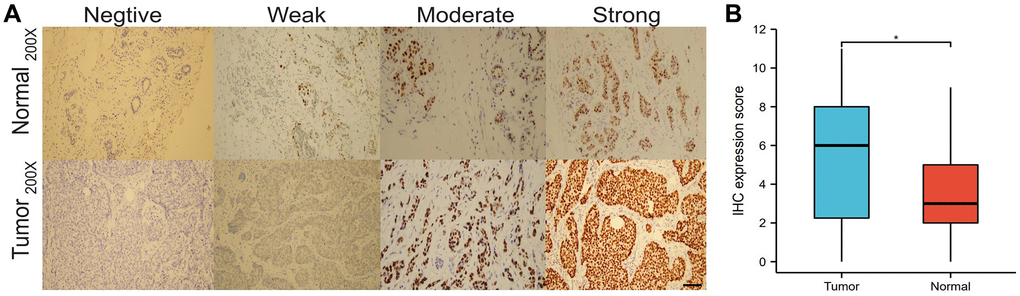 IHC expression of HNRNPA2B1. IHC expression of HNRNPA2B1 in normal and tumor tissues (A), and box-plot showed IHC expression score between tumor and normal (B). (*P **P ***P 