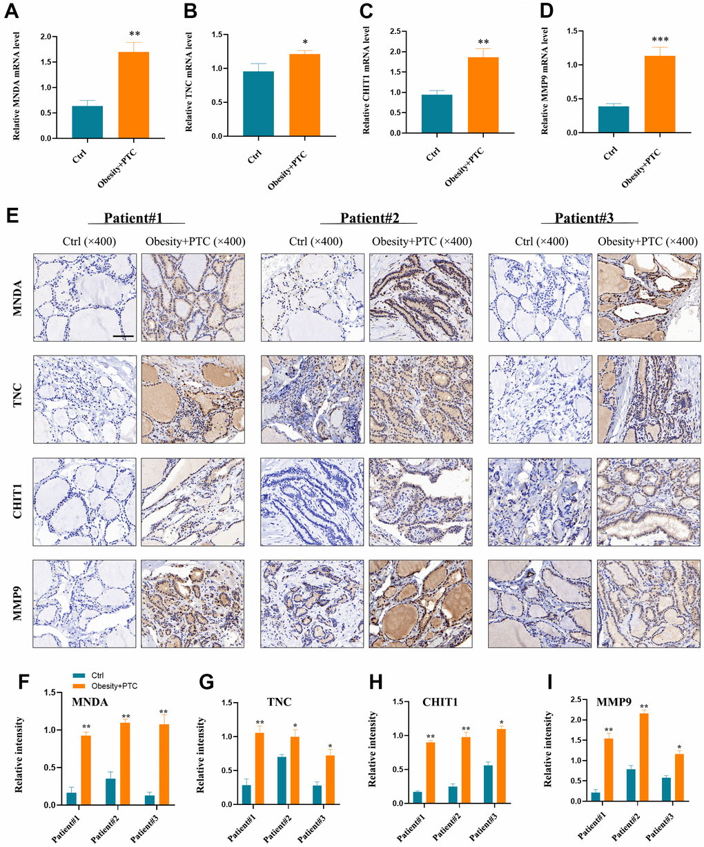 Experimental validation of hub genes. (A–D) MNDA, TNC, CHIT1 and MMP9 were found to be highly expressed in patients’ serum with obesity combined with PTC ((A) P B) P C) P D) P E–I) The expression of four hub genes in the patient tissues and the normal tissues (F) patient1: P G) patient1: P H) patient1: P I) patient1: P “***”, P “**”, P “*”, and P > 0.05 as “ns”.