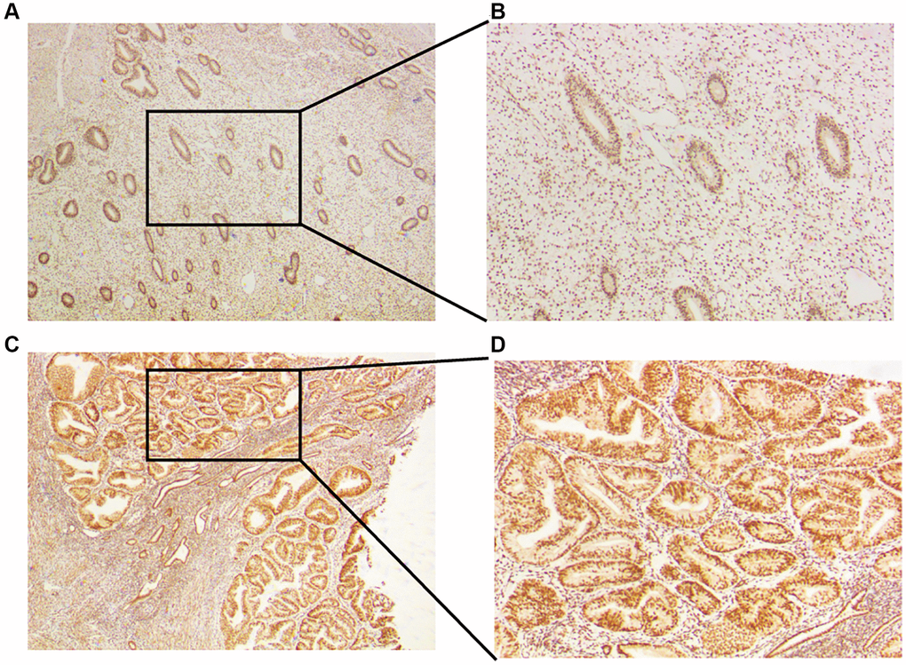 Expression of CLCN4 in the UCEC patients. (A, B) Immunohistochemical analysis of CLCN4 expression in normal endometrial tissues, an original magnification 40x, B original magnification 100x. (C, D) Immunohistochemical analysis of CLCN4 expression in the tumor tissues of UCEC patients, C original magnification 40x, D original magnification 100x.