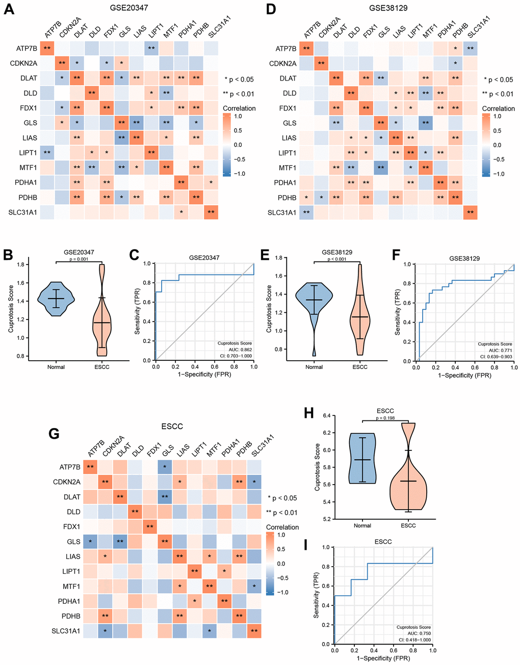 Construction of cuproptosis score diagnosis signature. (A) The heat map presented the correlation among the expression level of 12 CRGs in GSE20347 cohort. (B) Differential analysis of cuproptosis score between normal group and ESCC group in GSE20347 cohort. (C) ROC curves showed the diagnosis performance of GSE20347 cohort. (D) The heat map presented the correlation among the expression level of 12 CRGs in GSE38129 cohort. (E) Differential analysis of cuproptosis score between normal group and ESCC group in GSE38129 cohort. (F) ROC curves showed the diagnosis performance of GSE20347 cohort (C), GSE38129 cohort. (G) The heat map presented the correlation among the expression level of 12 CRGs in ESCC cohort. (H) Differential analysis of cuproptosis score between normal group and ESCC group in ESCC cohort. (I) ROC curves showed the diagnosis performance of ESCC cohort.