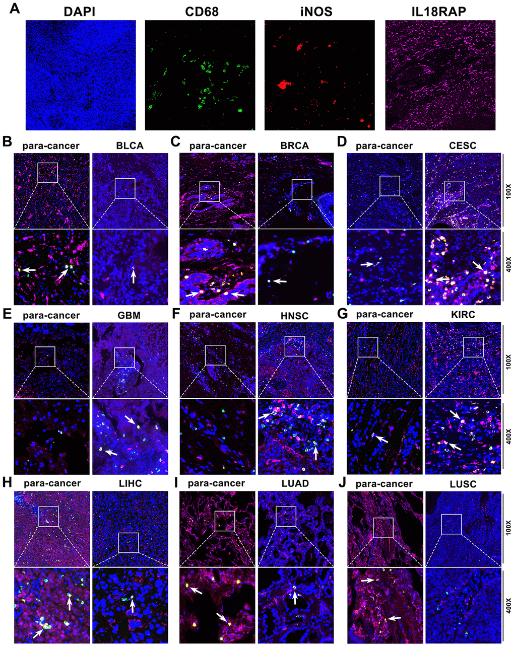 The expression of IL18RAP, CD68, and iNOS in 9 cancers and the corresponding paracancerous tissues detected by multiplex immunofluorescence staining. (A) The representative image of DAPI, CD68, iNOS, and IL18RAP, respectively. Blue represents the DAPI-stained nucleus; red represents CD68-positive cells; green represents iNOS-positive cells; and pink represents IL18RAP-positive area. (B–J) The representative immunofluorescence images of BLCA (B), BRCA (C), CESC (D), GBM (E), HNSC (F), KIRC (G), LIHC (H), LUAD (I), LUSC (J) and corresponding para-cancerous tissues. The white arrow indicates CD68 and iNOS double-positive cells.