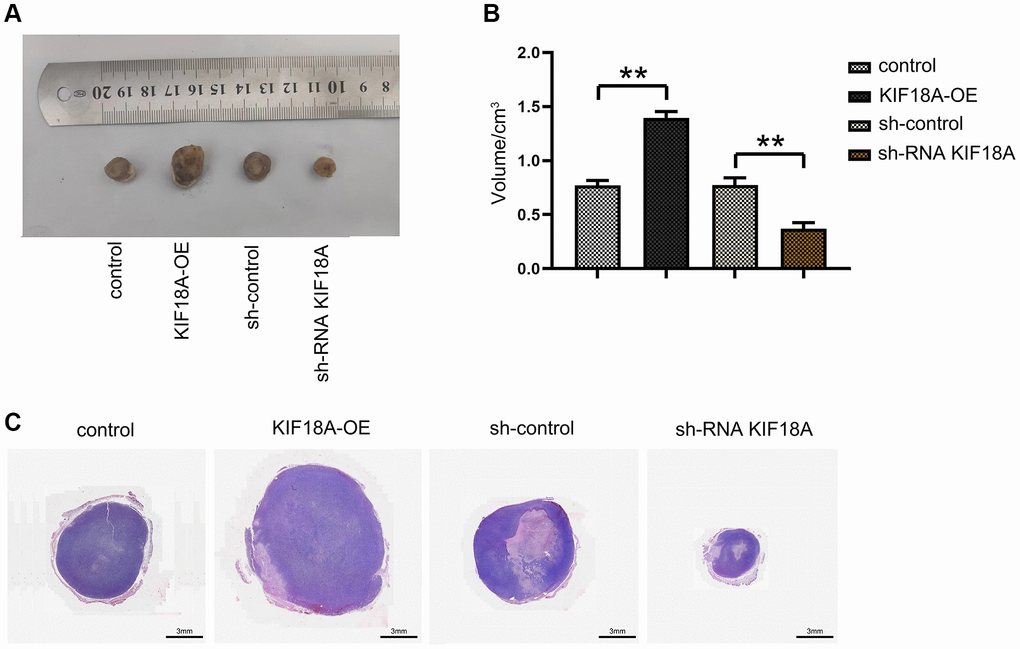 Effect of KIF18A on the development of CRC. (A) Diagrams of tumorigenesis in nude mice in sh-control group, sh-RNA KIF18Agroup, control group, KIF18A-OE group. (B) Statistics of tumor volume in nude mice in sh-control group, sh-RNA KIF18A group, control group, KIF18A-OE group. (C) Plots of HE staining results (**p N = 6).