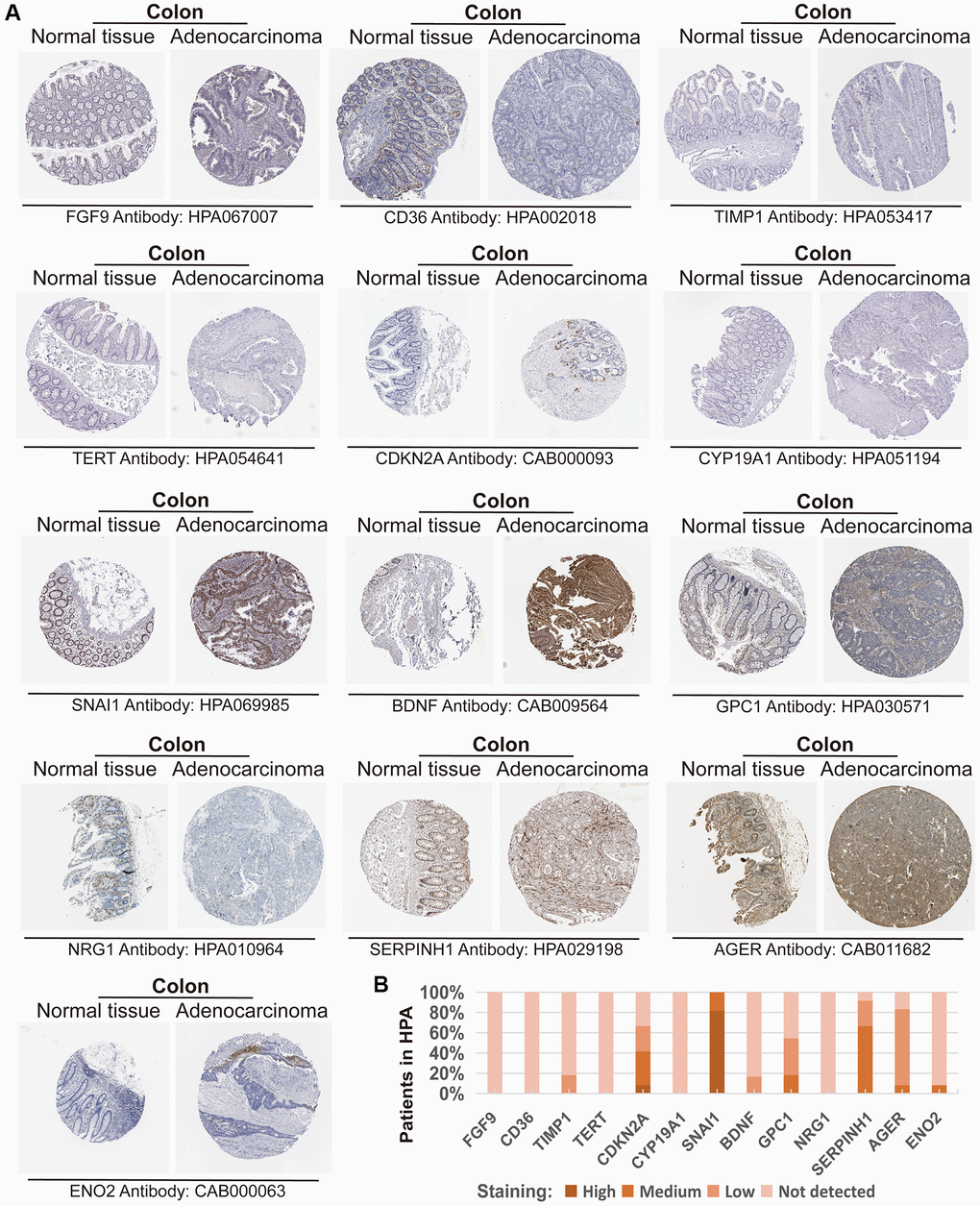 Expression of the protein encoded by the CAFRs-related gene in the Human Protein Atlas (HPA). (A) Immunohistochemical images of the protein encoded by some CAFRs-related genes in COAD normal and tumour tissue in the HPA. (B) The proportion of the protein encoded by some CAFRs-related genes that is expressed in the COAD of the HPA.