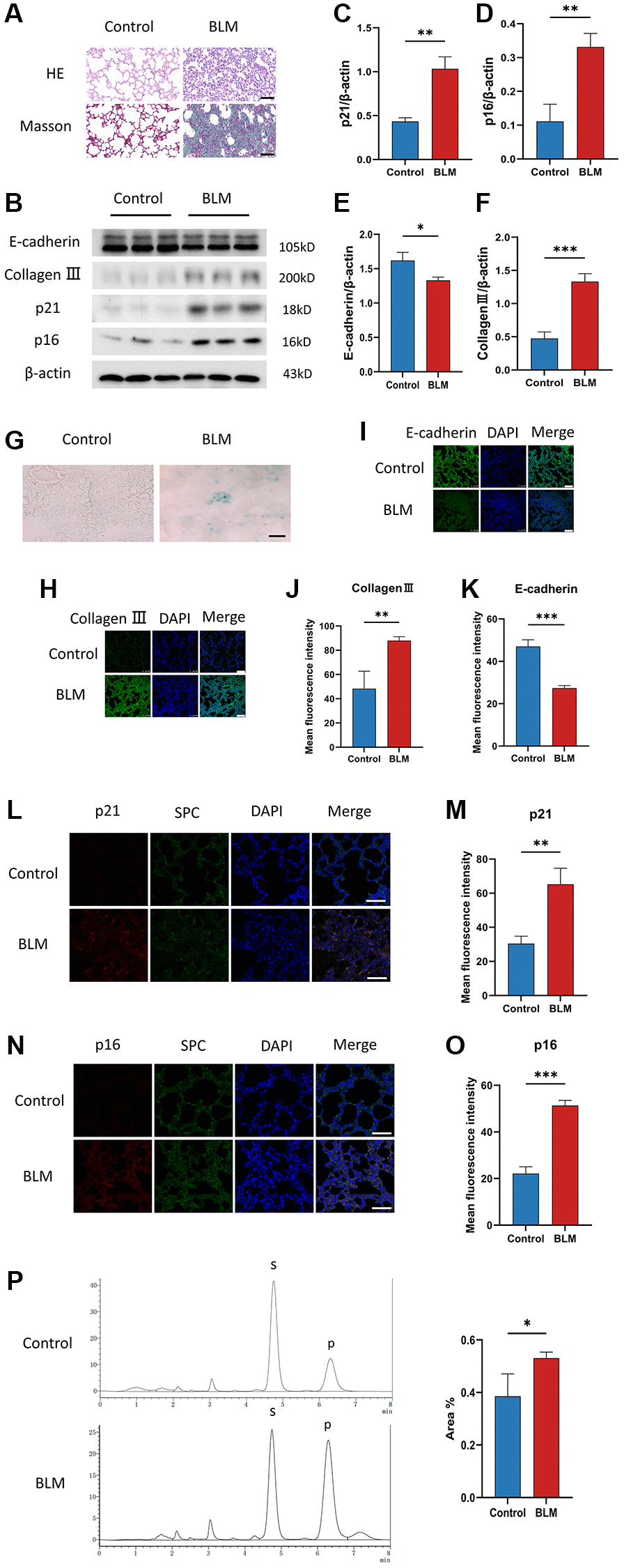 Cellular senescence occurs in BLM-induced lung fibrosis mice model. (A) HE and Masson staining reveal representative pictures of different lung tissue sections after 21 days of BLM treatment. Scale bar, 100 μm. (B–F) Western blotting using anti-E-cadherin, anti-collagen III, anti-p21, anti-p16, and anti-β-actin antibodies in mice treated with BLM or saline. The grayscale evaluations of the bands were adjusted to be equal to β-actin. Data were presented as the mean ± SD. *P t-test). **P t-test). ***P t-test). (G) SA-β-gal staining reveals representative images of different lung tissue sections. Scale bar, 100 μm. (H–K) The protein levels of collagen III and E-cadherin in different lung tissues were measured via immunofluorescence technique. DAPI was used to counterstain the nuclei. Scale bar 100 μm. Data were presented as the mean ± SD. **P t-test). ***P t-test). (L–O) Representative immunofluorescence shows colocalization of p21WAF1 or p16ink4a (Red) and SPC (Green) in lung tissue. DAPI was used to counterstain the nuclei. Scale bar, 50 μm. Data were presented as the mean ± SD. **P t-test). ***P t-test). (P) High performance liquid chromatography shows FUT8 activity in mice. Data are the percentage of the area of P divided by the area of S+P and presented as the mean ± SD. P is the fucosylation product, and S is the peptide substrate. *P t-test).