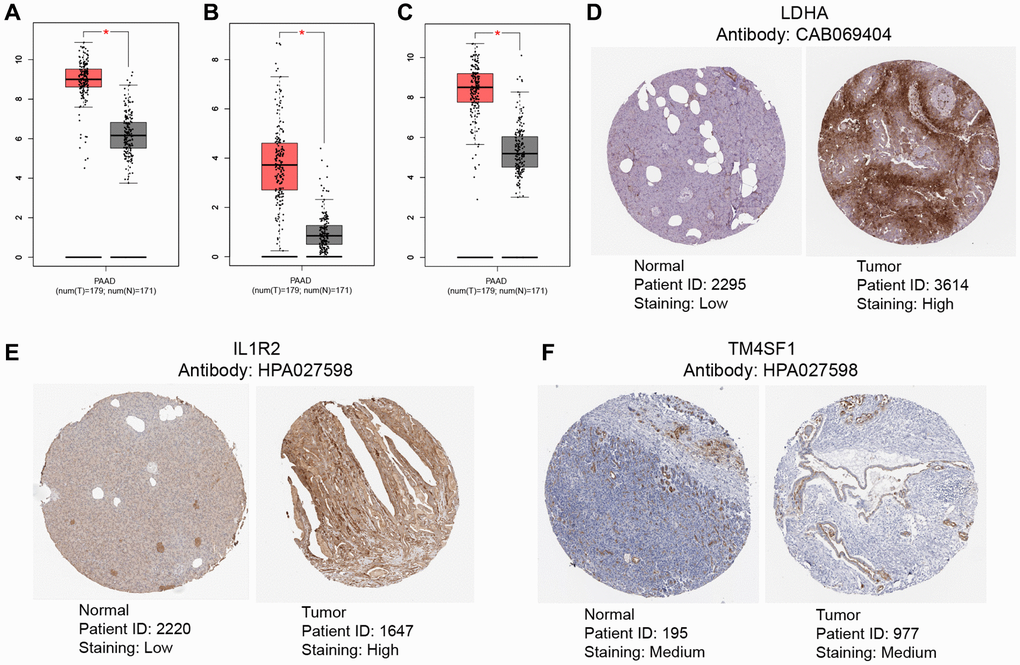 Validation of levels of gene expression. In pancreatic tumor tissues, the expression levels of LDHA (A), IL1R2 (B), and TM4SF1 (C) were considerably greater than in healthy tissues. Immunohistochemical examination indicated that the expression levels of LDHA (D) and IL1R2 (E) were considerably elevated in pancreatic tumor tissues compared to healthy tissues, TM4SF1 (F) was moderately expressed in both pancreatic tumor tissues compared to healthy tissues.