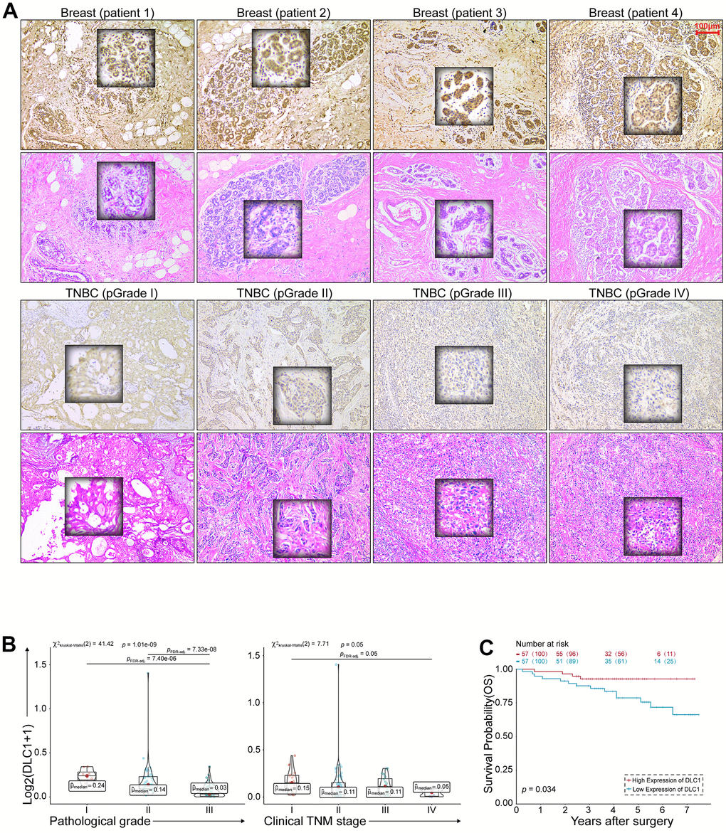 DLC1 expression correlates with the anticancer properties of TNBC. (A) HE and IHC staining of TNBC. Scale bar = 100 μm. (B) Correlation of DLC1 immunostaining intensity with clinical TNM stage and histopathological grade of TNBC, respectively. (C) Kaplan-Meier survival curves for overall survival of 114 patients with TNBC according to the DLC1 expression. Patients were stratified into high-expression and low-expression groups by median expression. (* p 