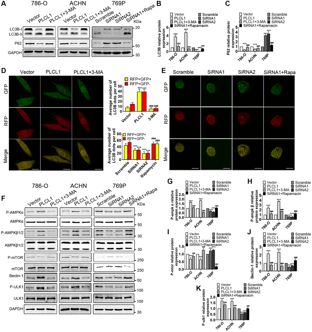 PLCL1 promotes autophagic flux by regulating the AMPK/mTOR signalling pathway in RCC cells. (A–C) Expression of LC3B and p62 in RCC cells with different treatments was examined using western blotting with quantitative analysis. GAPDH was used as a loading control. (D, E) 786-O and 769P cells transfected with GFP-mRFP-LC3B adenovirus were analysed using immunofluorescence. Autolysosome (red dots) and autophagosome (yellow dots) formation are shown using confocal microscopy and were quantitively analysed. Scale bar, 20 μm. (F–K) Representative western blotting and quantitative analysis of AMPK/mTOR signalling pathway-related proteins. Data are shown as the mean ± SE from three independent experiments. Student’s t test was performed to determine statistical significance between two groups. *P **P ***P #P #P #P 