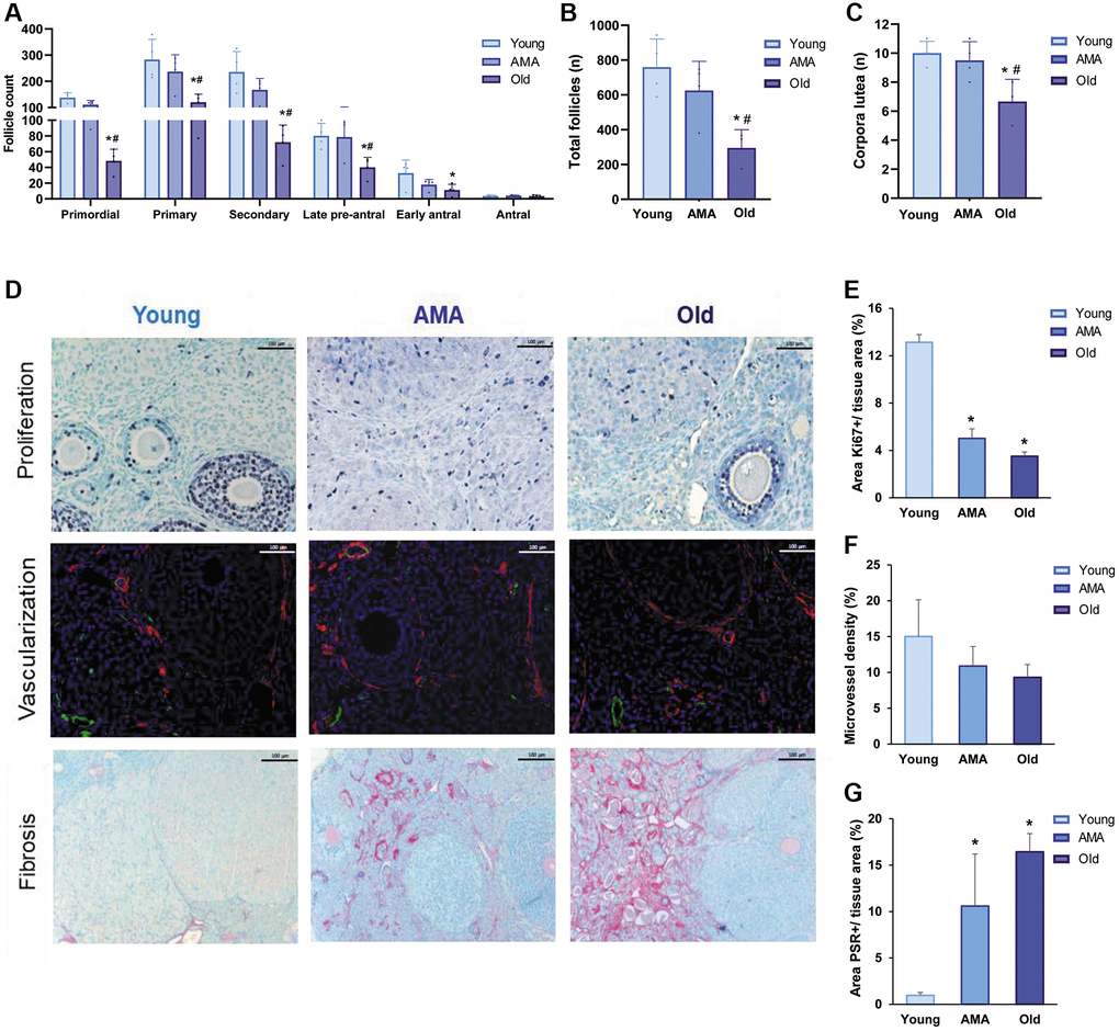 Histological analysis of the follicle reserve and ovarian stroma of a NOD/SCID mouse model for physiological human aging. (A) The follicular analysis of primordial, primary, secondary, late pre-antral, early antral, and antral follicles in young, advanced maternal age (AMA), and old mice notices a negative impact of age. The total number of follicles (B) and corpora lutea (C) are also affected. (D) Photomicrographs of the ovarian stroma, showing Ki67-positive proliferative cells in purple (top row), isolectin-B4-positive endothelial cells in green and a-smooth muscle actin in red (middle row), and collagen fibrils in red (bottom row). The black and white scale bars are set to 100 μm. Quantification of proliferation (E), vascularization (F), and fibrosis (G) in the ovaries of young, AMA, and old mice shows that the effects of age are mirrored in the ovarian stroma. All analyses were based on four samples per group. *p #p 