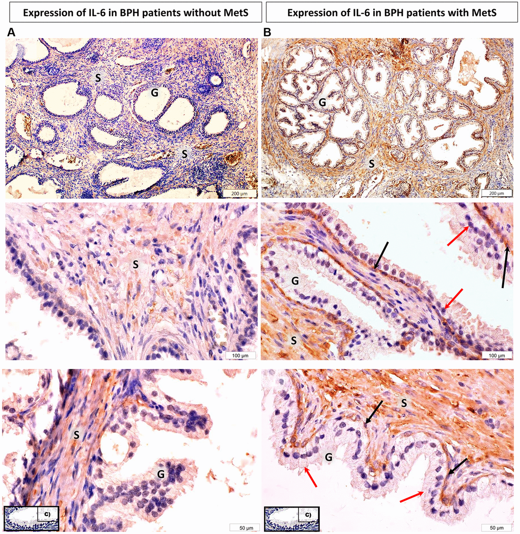 Microscopic image of the expression of the cytoplasmic immunohistochemical reaction to IL-6. (A) microscopic specimen of the prostate in a patient with benign prostatic hyperplasia and without MetS, (B) microscopic specimen of the prostate in a patient with benign prostatic hyperplasia and MetS. C - negative control (reaction without the use of an antibody). The cytoplasmic immunohistochemical reaction expressing IL-6 was stained brown (DAB +), S - prostate stroma, G - glandular part, ↑ - luminal cells, ↑ basal cells.