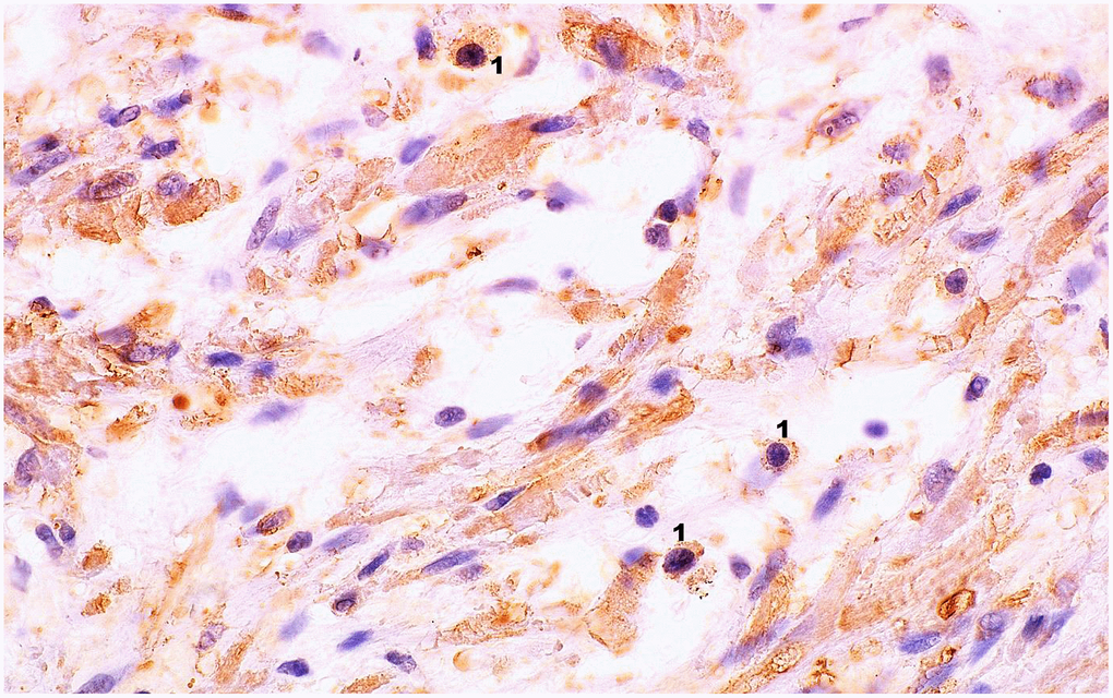 Microscopic image of the expression of the cytoplasmic immunohistochemical reaction to IL-6. Microscopic preparation of prostate stroma tissue with benign hyperplasia. Cytoplasmic immunohistochemistry showing IL-6 expression was stained brown (DAB +), 1 – lymphocytes, 600× magnification.