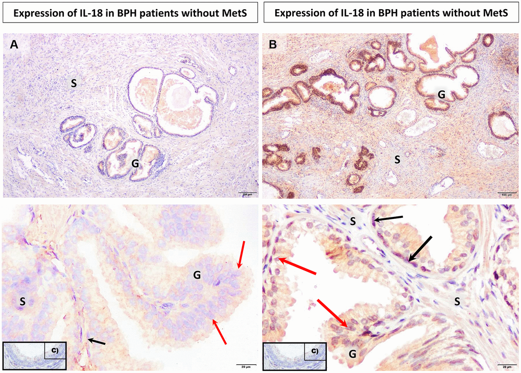 Microscopic image of the expression of the cytoplasmic immunohistochemical reaction to IL-18. (A) microscopic specimen of the prostate in a patient with benign prostatic hyperplasia and without MetS, (B) microscopic specimen of the prostate in a patient with benign prostatic hyperplasia and MetS, C - negative control (reaction without the use of an antibody). The cytoplasmic immunohistochemical reaction expressing IL-18 was stained brown (DAB +), S - prostate stroma, G - glandular part, ↑ luminal cells, ↑ basal cells.