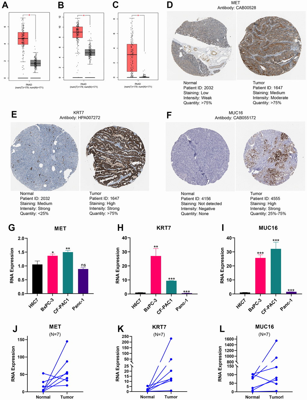 Expression levels of MET, KRT7, and MUC16. The expression of MET (A), KRT7 (B), and MUC16 (C) at RNA level. Immunohistochemical images of MET (D), KRT7 (E), and MUC16 (F). The expression differences of MET (G), KRT7 (H), and MUC16 (I) between pancreatic ductal epithelium and pancreatic cancer cell lines. The expression difference of MET (J), KRT7 (K), and MUC16 (L) between pancreatic tumour and adjacent tissue. (*p