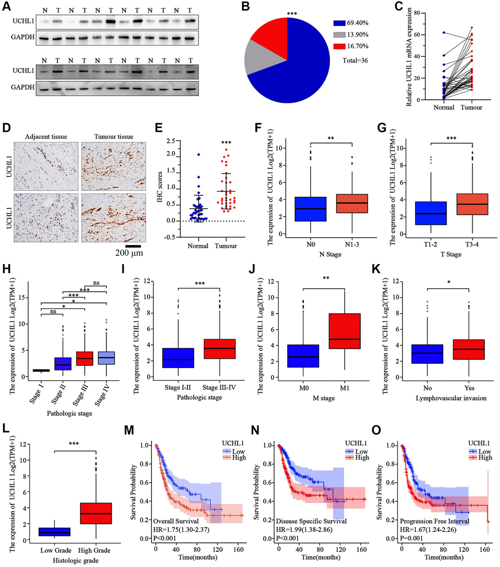 The expression levels of UCHL1 are frequently up-regulated in UBC tissues and is positively associated with advanced clinical stage and poor outcomes in UBC patients. (A, B) WB detection of UCHL1 protein expression pattern in 36 matched sample pairs of UBC tumor and adjacent normal tissues. (C) PCR detection of UCHL1 mRNA expression pattern in 36 matched sample pairs of UBC tumor and adjacent normal tissues. (D, E) IHC method detection and IHC score comparison of UCHL1 protein expression pattern in normal adjacent tissues and UBC tumor tissues (n = 3). (F, G) UCHL1 mRNA expression comparison between UBC patient subgroups with different N-T stages. (H–L) UCHL1 mRNA expression comparison between UBC patient subgroups with different pathological stages, M stages, lympho-vascular invasion status and histologic grade. (M–O) Kaplan-Meier analysis on the correlation of UCHL1 expression level with UBC patients’ prognostic endpoints including overall survival, disease-specific survival and progression free survival.