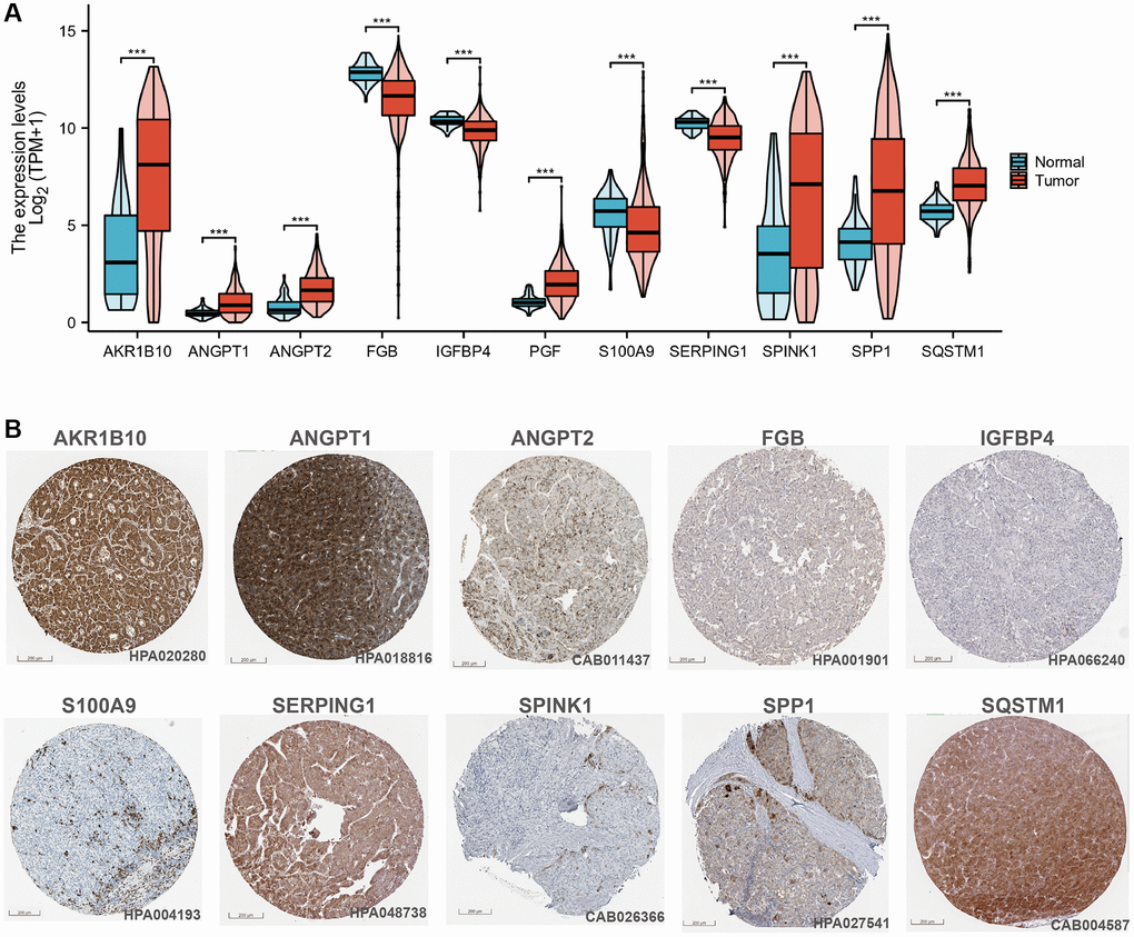 CAFRss-related genes in HCC. (A) Violin diagram of the expression of CAFRss genes in HCC tumour tissue and normal tissue. (B) Immunohistochemical images of proteins encoded by CAFRss-related genes in HCC tumour tissue. *P **P ***P 