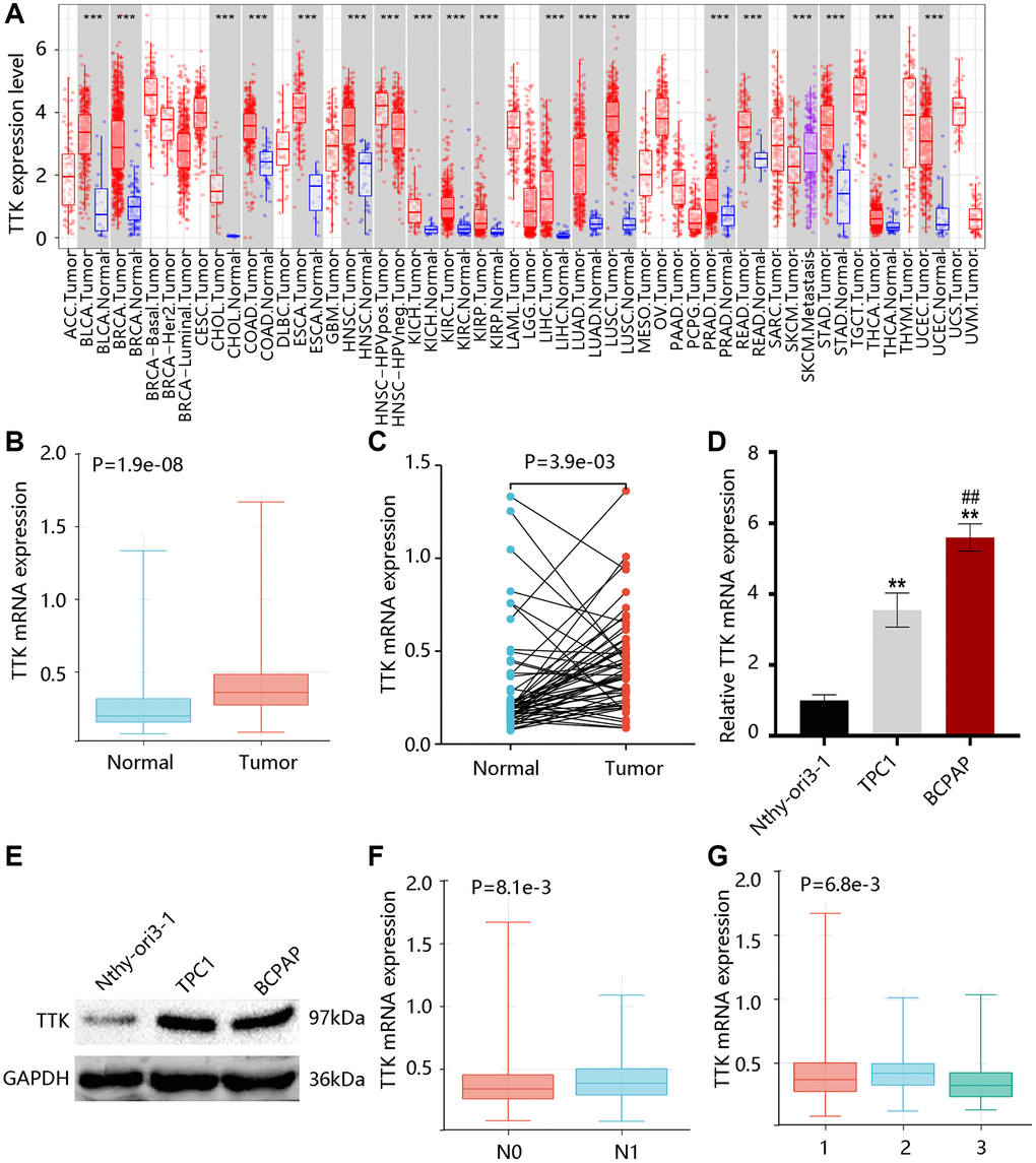 TTK expression profile in papillary thyroid cancer (PTC). (A) TTK expression in pan-cancer. The elevated TTK mRNA level in PTC by the (B) unpaired and (C) paired t-tests using TCGA data. Higher TTK (D) mRNA and (E) protein expression in PTC cells. Relationship between TTK and (F) N stage, as well as (G) histological subtype. 1: PTC-classical; 2: PTC-tall cell; 3: PTC-follicular.