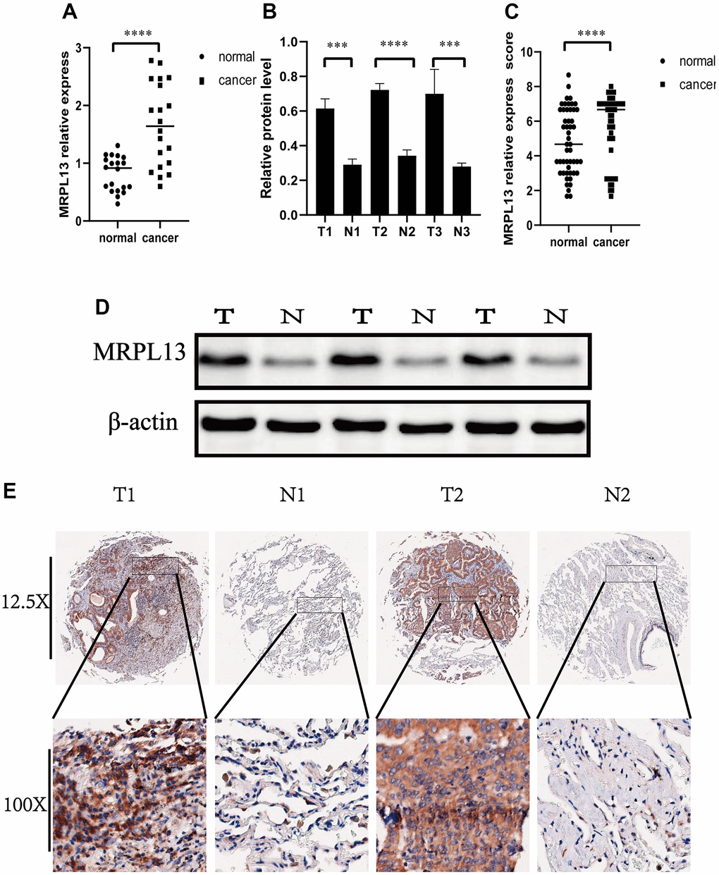 Expression of MRPL13 in cancer and normal tissues. (A) Fluorescence real-time quantitative PCR was used to detect the expression of MRPL13 in tumor tissues and normal tissues adjacent to cancer. (B) Western blot to verify the expression of MRPL13 in cancer and normal tissues adjacent to cancer (the experiment was repeated thrice). (C) Immunohistochemistry score to verify the expression of MRPL13 in cancer and normal tissues adjacent to cancer. (D) Western blot representative picture. (E) Immunohistochemical representative pictures of cancer patients and normal patients (panorama above, detail below). *p-value 