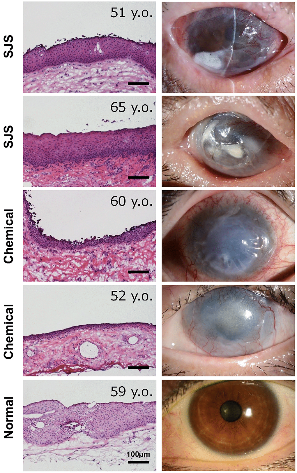 Histology of conjunctival tissues from patients with limbal stem cell deficiency. Representative ocular images of two cases with Stevens-Johnson syndrome (SJS), two cases with chemical injury, and one healthy subject. The histological sections were stained with hematoxylin and eosin stain. Scale bars indicate 100 μm.