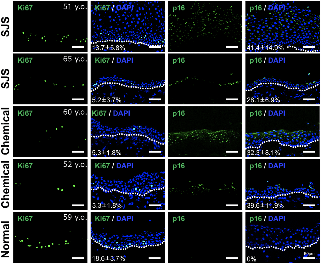 Presence of senescent cells in pathological conjunctival epithelium. Immunostaining of p16 and Ki67 in patients with Stevens-Johnson syndrome (SJS) or chemical injury, and in healthy individual. The positivity rate was calculated by quantifying the percentage of positive cells per sample (mean ± standard deviation) based on five independent fields. Scale bars indicate 50 μm.