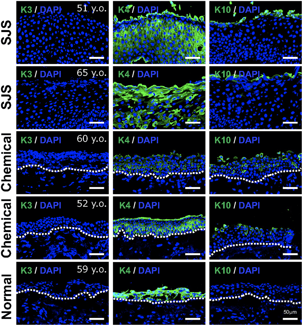 Expression pattern of keratins in pathological conjunctival epithelium. Immunostaining of keratin 3 (K3), keratin 4 (K4), and keratin 10 (K10) in patients with Stevens-Johnson syndrome (SJS) or chemical injury, and in healthy individual. Scale bars indicate 50 μm.