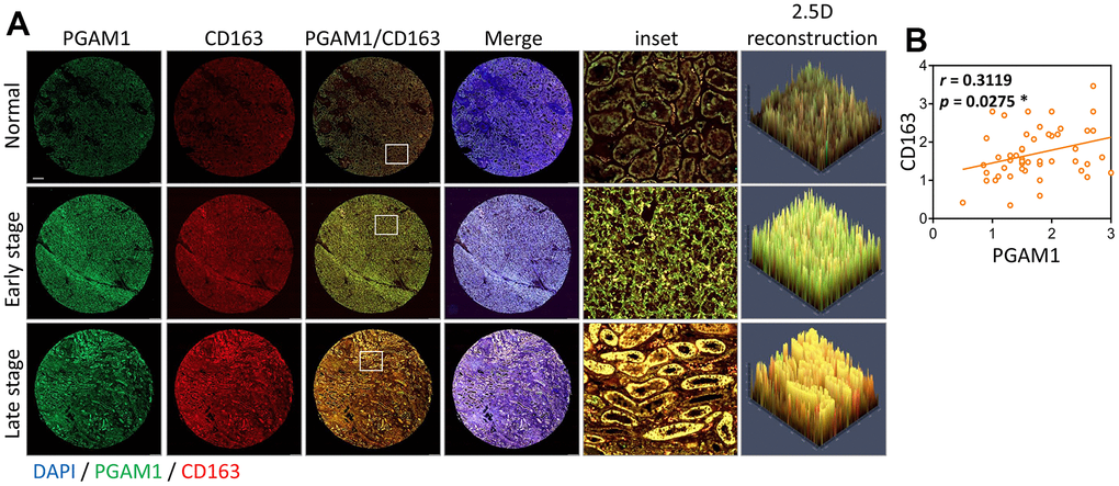 Analyzing the co-occurrence of PGAM1 and CD163 in tumor biopsies during KIRC development. (A) Merge indicates PGAM1/CD163/DAPI; inset indicates local magnification; 2.5D reconstructed image shows the local fluorescence changes, morphology and fluorescence intensity. The merge image displays PGAM1/CD163/DAPI, while the inset exhibits a local magnification. The 2.5D reconstructed image showcases local fluorescence changes, morphology, and fluorescence intensity. (B) The Pearson's correlation coefficient was employed to visualize the degree of overlap between PGAM1 and CD163 fluorescence signals.