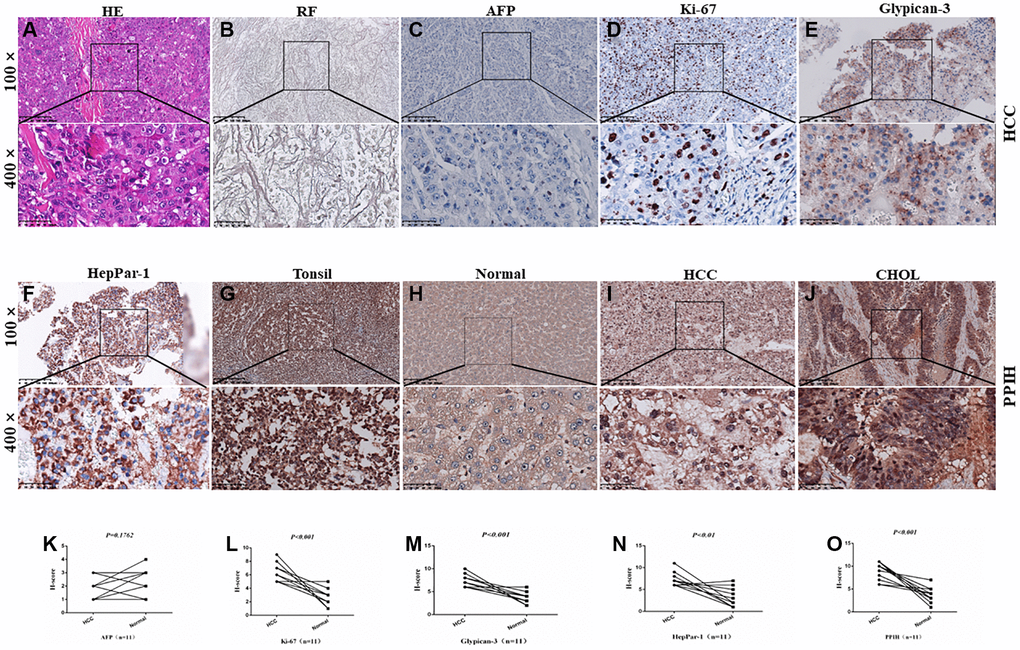 Diagnosis and IHC identification of HCC. (A) HE staining image of HCC. (B) Reticular fiber (RF) staining picture of HCC. (C–F) IHC for AFP, Ki-67, Glypican-3, and HepPar-1 in HCC. (G–J) Representative IHC images of PPIH in tonsil (positive control), HCC, CHOL (cholangiocarcinoma) specimens and matched adjacent normal tissues (H). Regions in squares are magnified 4×; in bottom panels. (K–O) Relative AFP (K) Ki-67 (L) Glypican-3 (M) HepPar-1 (N) PPIH (O) expression scores in HCC and paired normal tissues.