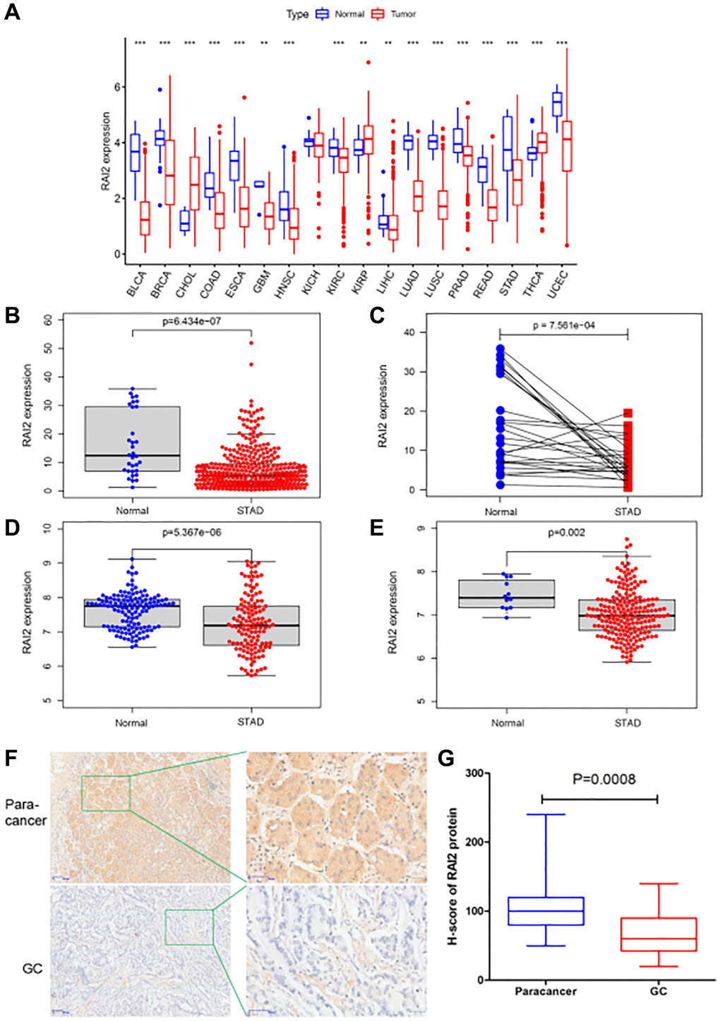 The expression level of RAI2 in GC tissues. (A) The expression of RAI2 in various kinds of tumors from TCGA database. (B) The expression of RAI2 between normal tissues and GC tissues from TCGA database. (C) RAI2 expression in paired samples of GC from TCGA database. (D, E) The expression of RAI2 mRNA in normal tissues and GC tissues from GS29272 (D) and GSE26942 (E) in GEO datasets, respectively. (F) The immunohistochemistry (IHC) assay was conducted to examine the expression of RAI2 protein in 20 GC tissues and paracancer tissues (50×, 200×). (G) The statistical analysis of RAI2 expression in GC tissues and paracancer tissues. **P 