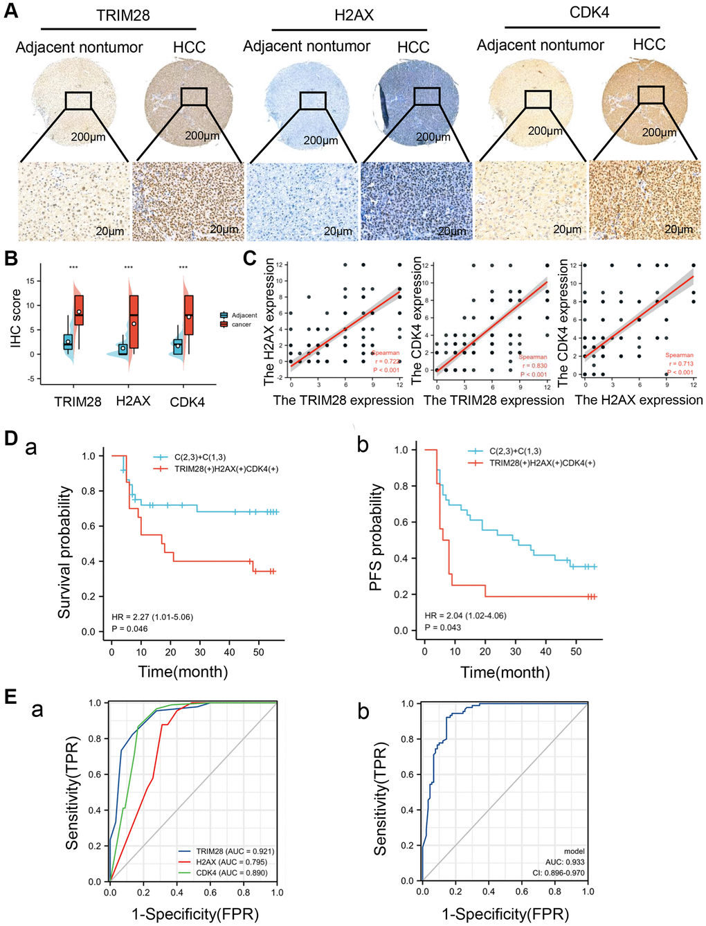 High TRIM28, H2AX, and CDK4 expression is associated with poor prognosis in patients with HCC. (A) An Immunohistochemical analysis of TRIM28, H2AX and CDK4 expression in HCC tissues and adjacent non-tumorous tissues (n = 90). (B) The expression of TRIM28, H2AX and CDK4 in HCC and corresponding adjacent nontumor tissues. ***p C) The association between the expression of TRIM28, H2AX and CDK4 in HCC patients. (D (a, b)) A Kaplan-Meier analysis of TRIM28, H2AX and CDK4 expression those three genes co-expression for overall survival and PFS in an independent cohort 90 HCC patients. (E (a, b)). The AUC for ROC curve analyses for TRIM28 (AUC = 0.921), H2AX (AUC = 0.795), CDK4 (AUC = 0.890) expression and three gene co-expression (AUC = 0.933) in our independent cohort of HCC.