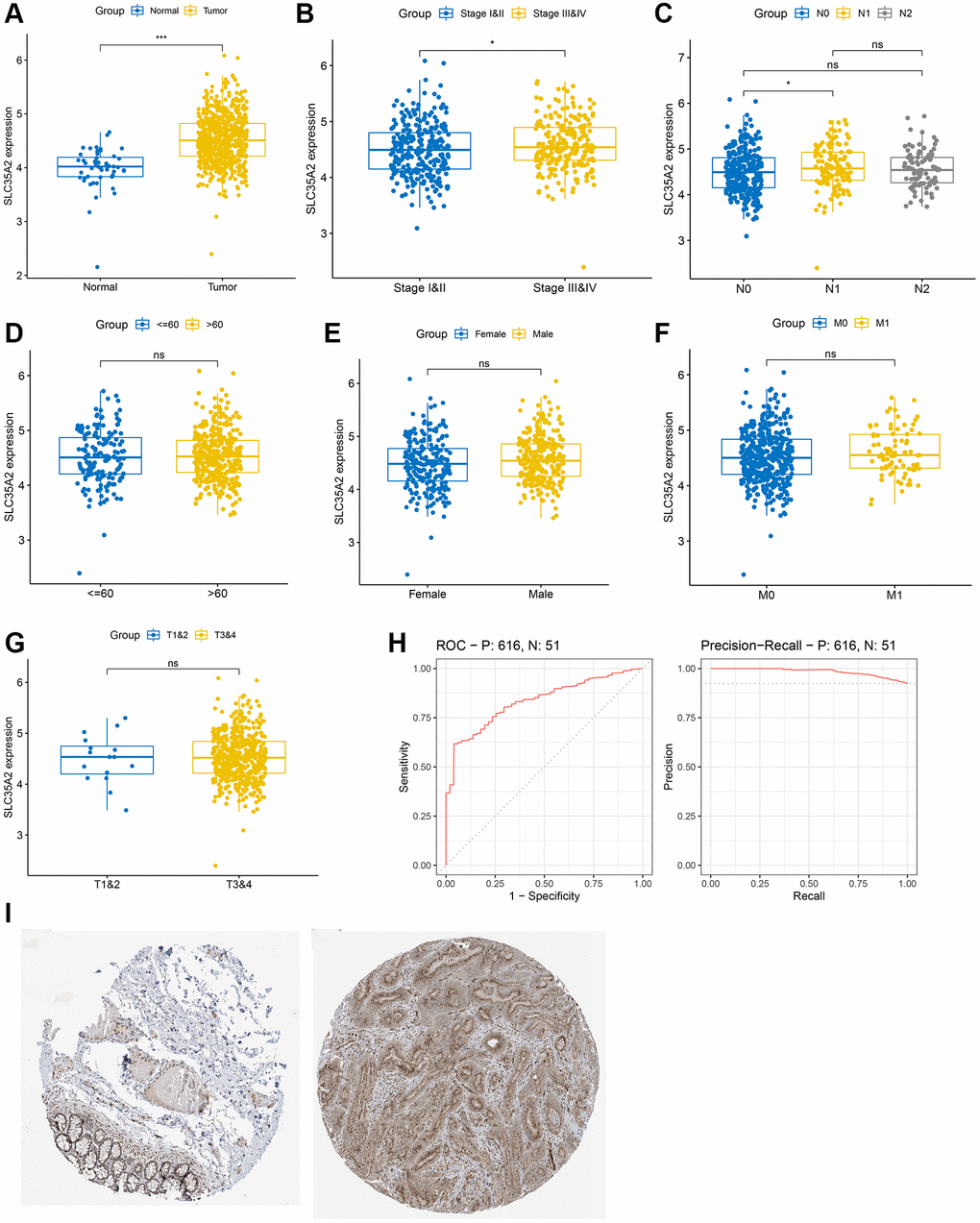 The relationship of SLC35A2 expression and clinical features in patients with colorectal cancer. (A) The expression of SLC35A2 in colorectal carcinoma was higher than that of normal tissues. (B) SLC35A2 expression was higher in Stages III and IV than in Stages I and II. (C) The difference of SLC35A2 expression between N0 and N1 was statistically significant (p D–G) The expression level of SLC35A2 in different sexes, age, M and T stages was not statistically significant (p > 0.05). (H) The diagnostic value of SLC35A2 in CRC was assessed by drawing ROC and PRC curves. The AUC of the ROC curve is 0.834 and the PRC curve is 0.984 (*p **p ***p p > 0.05). (I) Representative images of IHC staining of SLC35A2 in normal colon tissue (left) and colorectal cancer tissue (right) was presented.